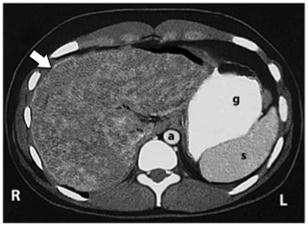 Abdominal CT of the case revealed irregular contours and diffuse granular heterogeneity of the liver parenchyma, supporting cirrhosis.