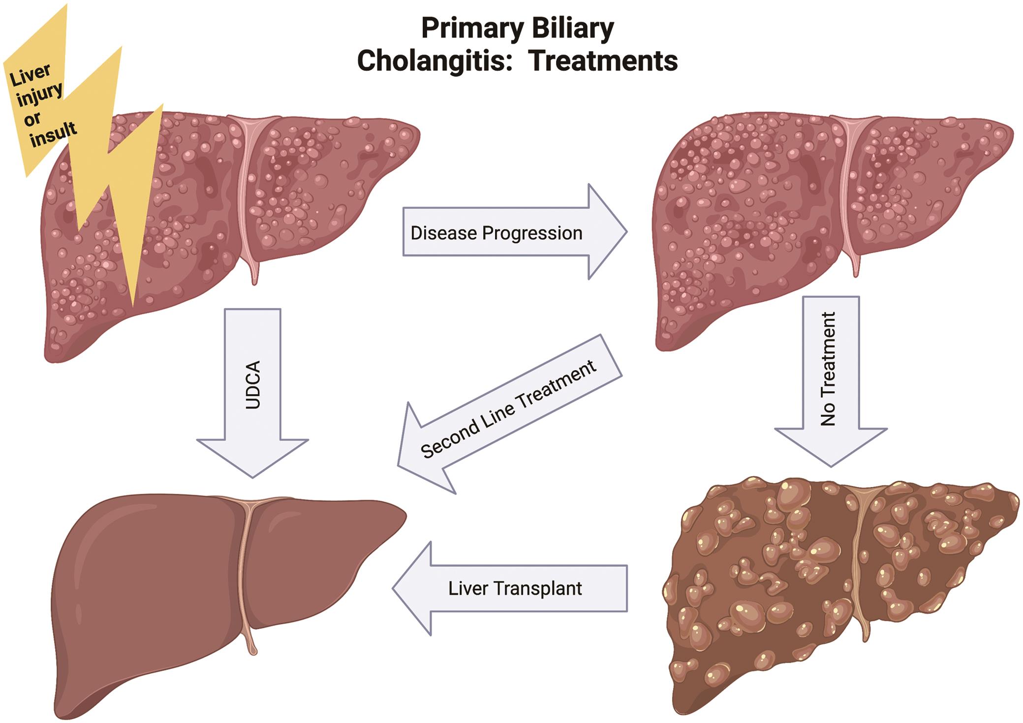 Treatment of primary biliary cholangitis.
