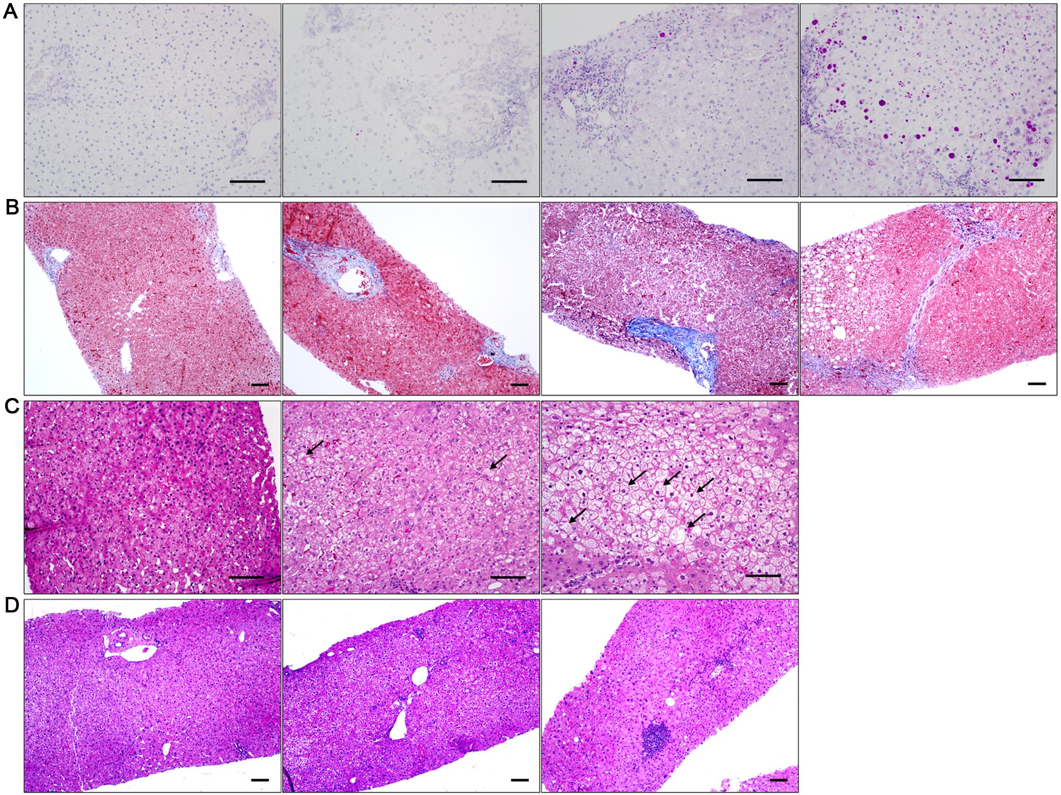 Liver histopathology.