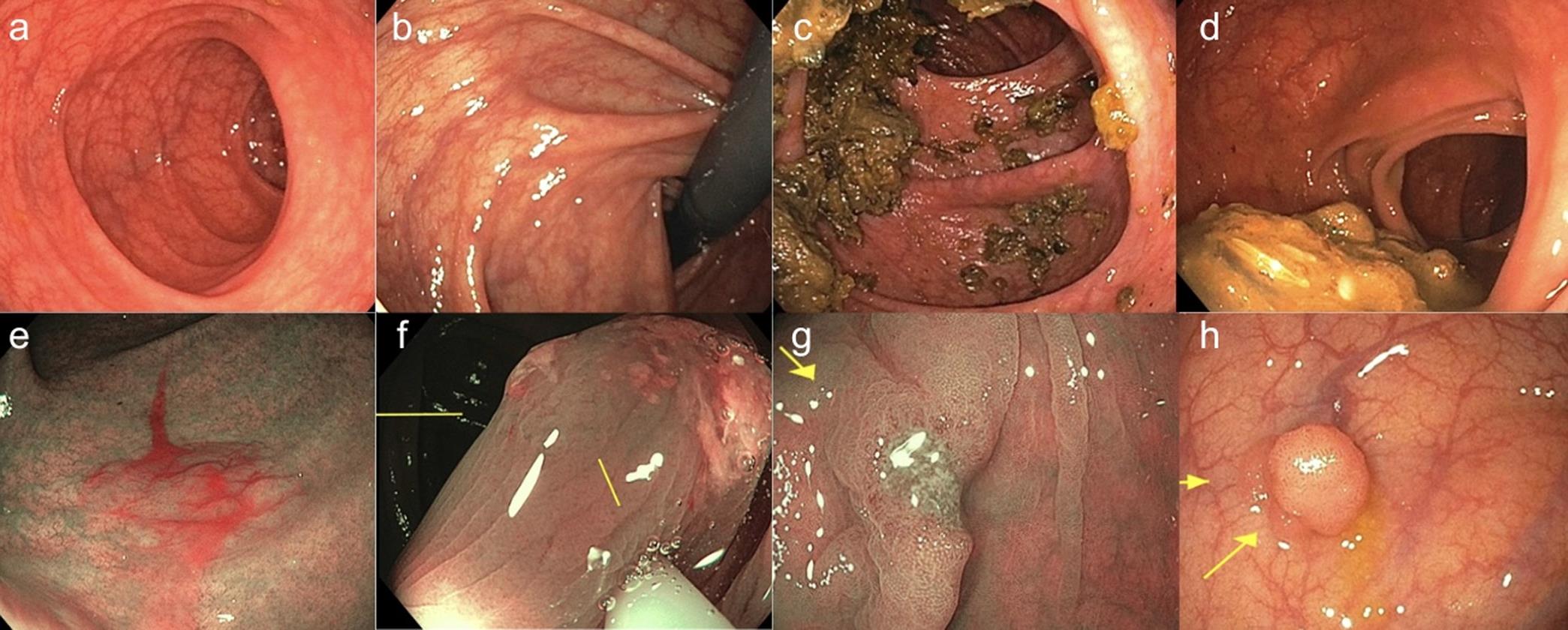 Visualization of bowel preparation quality’s impact on lesion detection: missed lesions in poor preparation scenarios.
