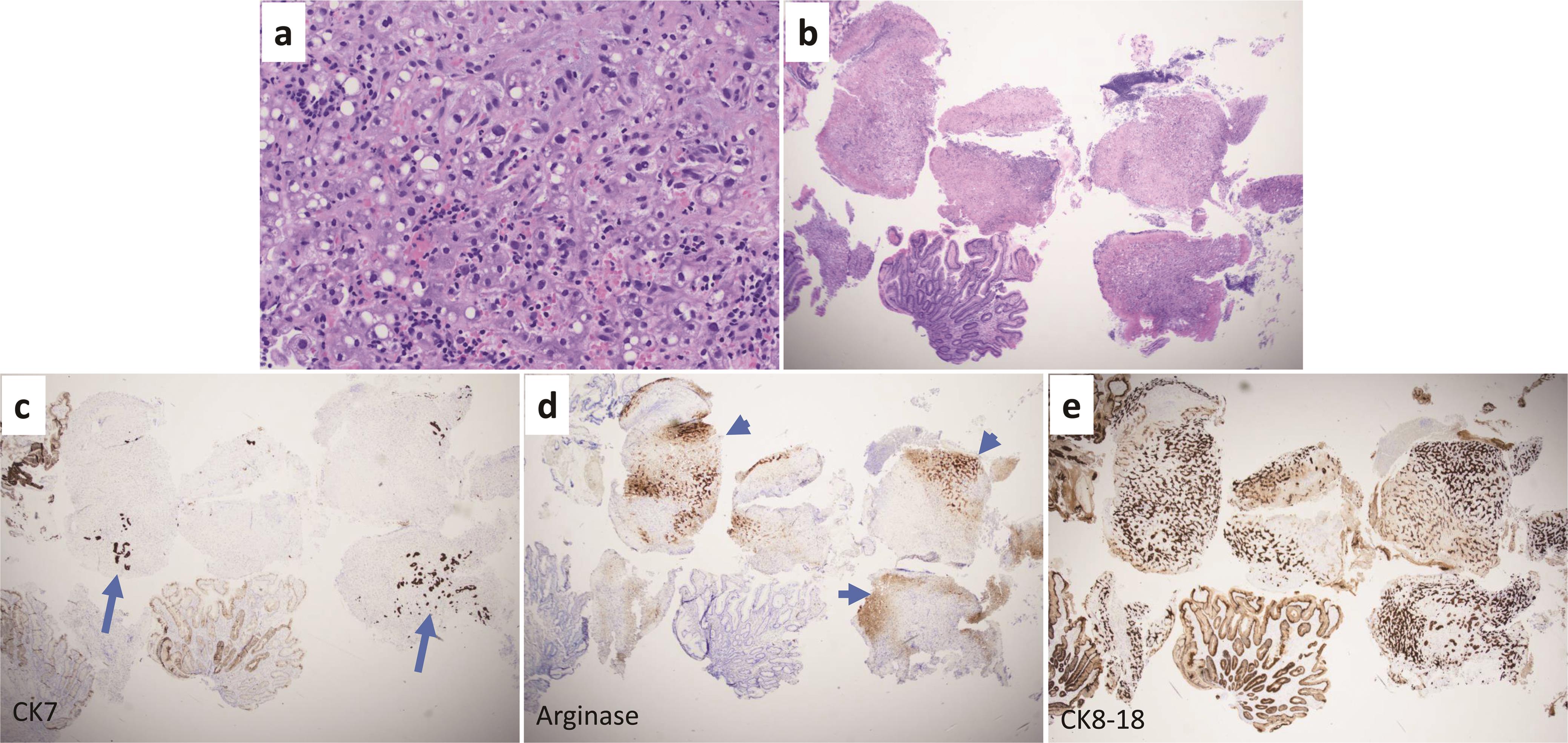Representative images of biopsy samples from a duodenal ulcer penetration that involved the liver by Hematoxylin & Eosin staining: (a) 200 ×; (b) 40 ×; (c) immunohistochemistry of CK7; (d) arginase; and (e) and CK8/18.