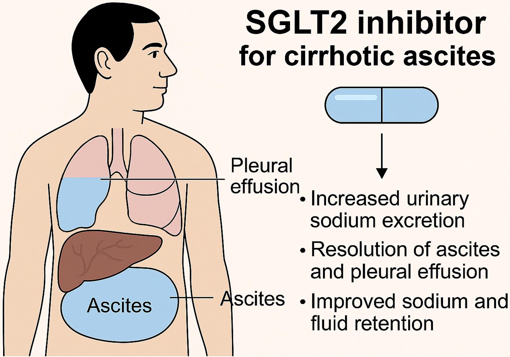 Complete Resolution of Refractory Ascites and Pleural Effusion with ...