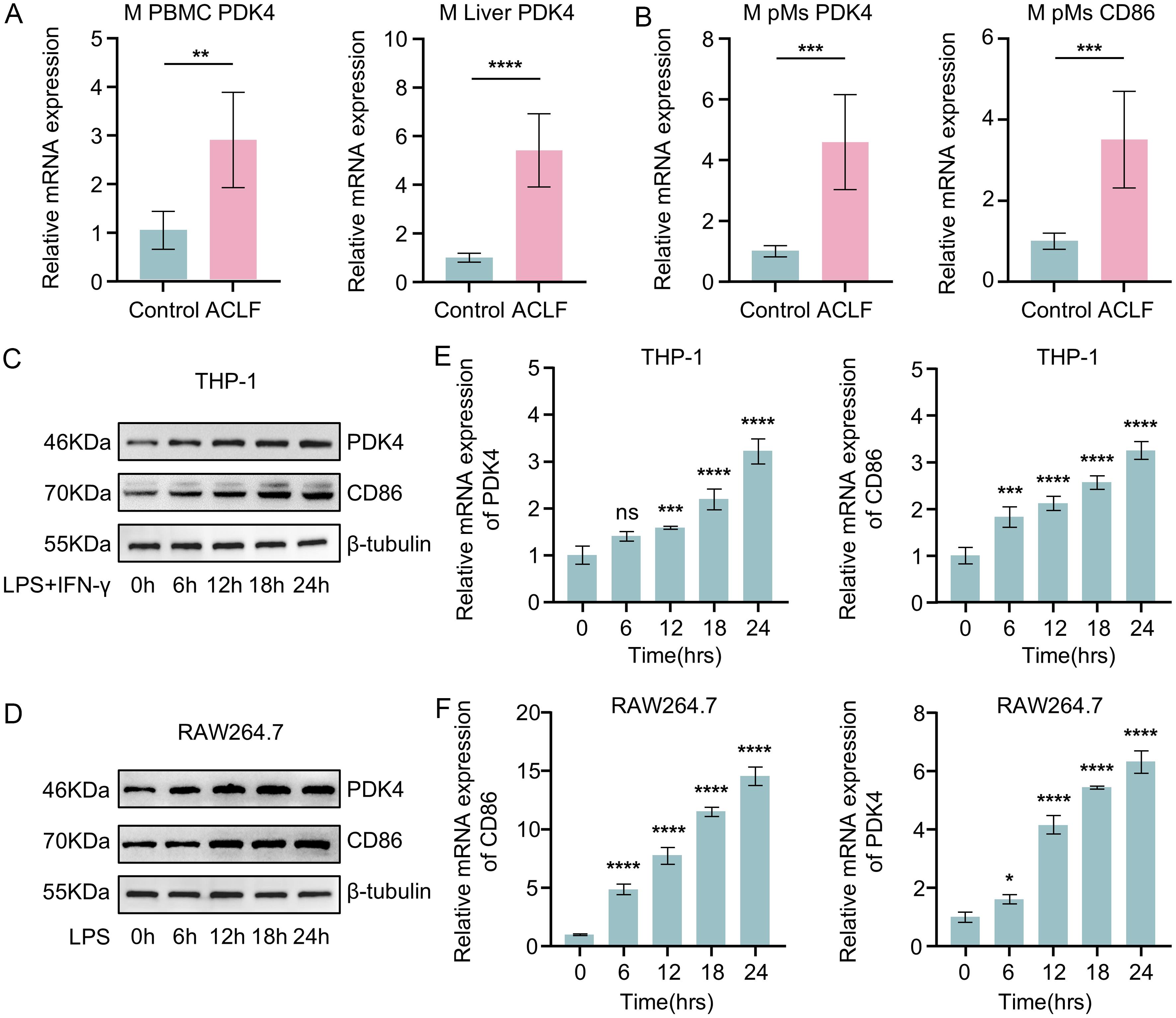 Analysis of PDK4 expression in ACLF-related macrophage polarization models.