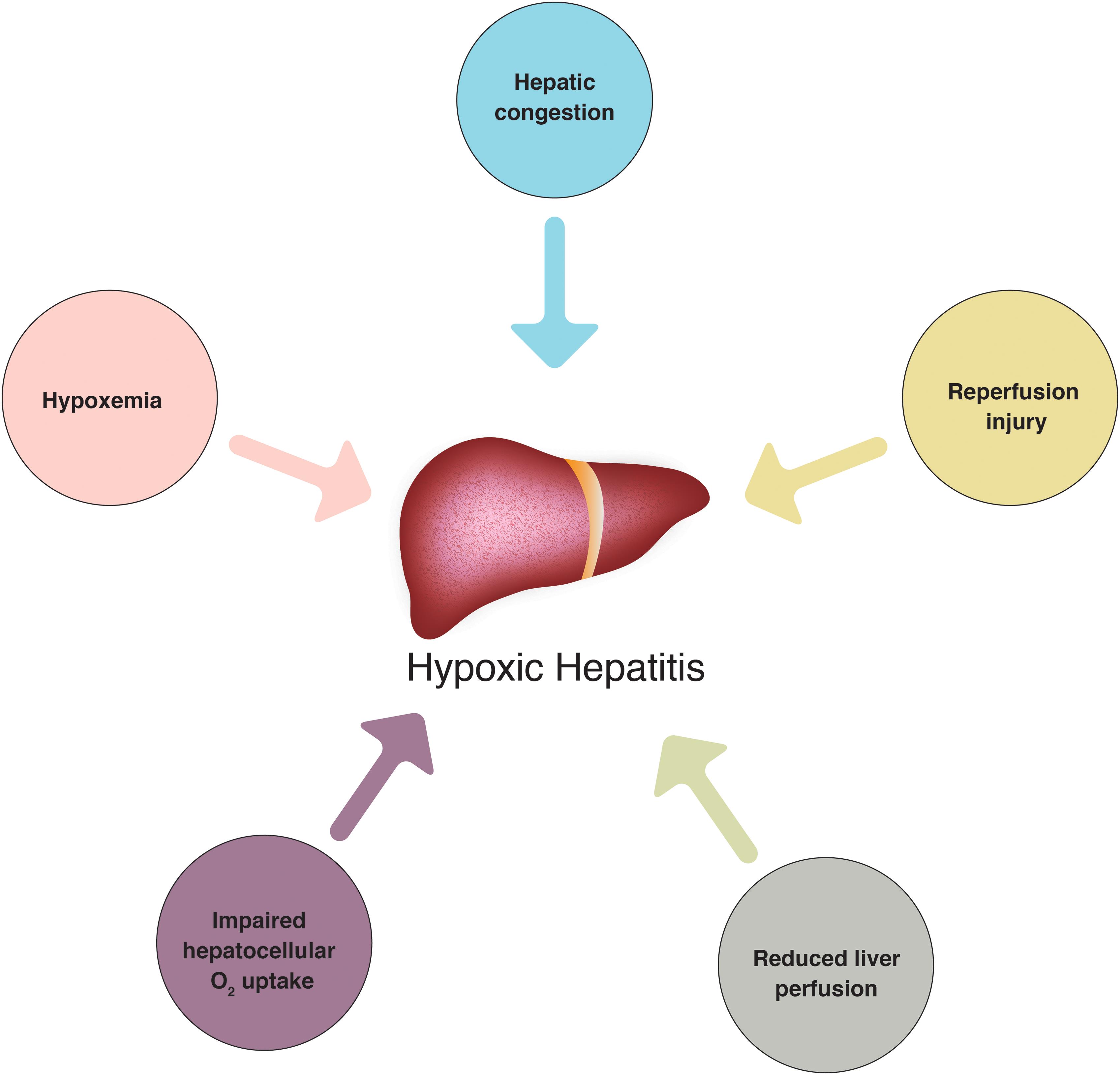 Multifactorial contributors to hypoxic hepatitis.