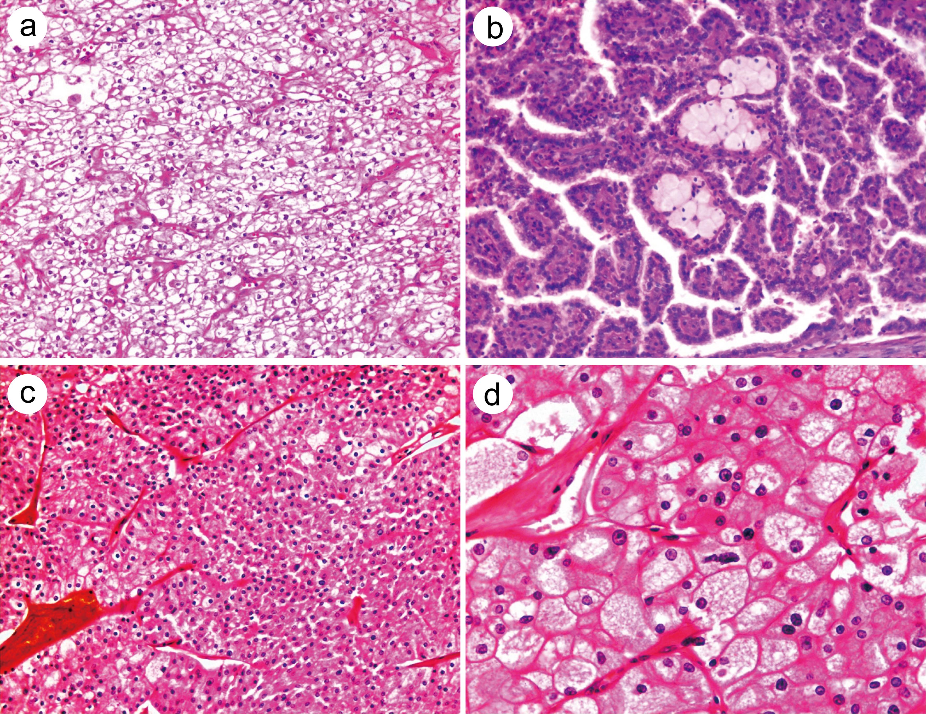 The microscopic features of the main morphological types of renal cell tumors.
