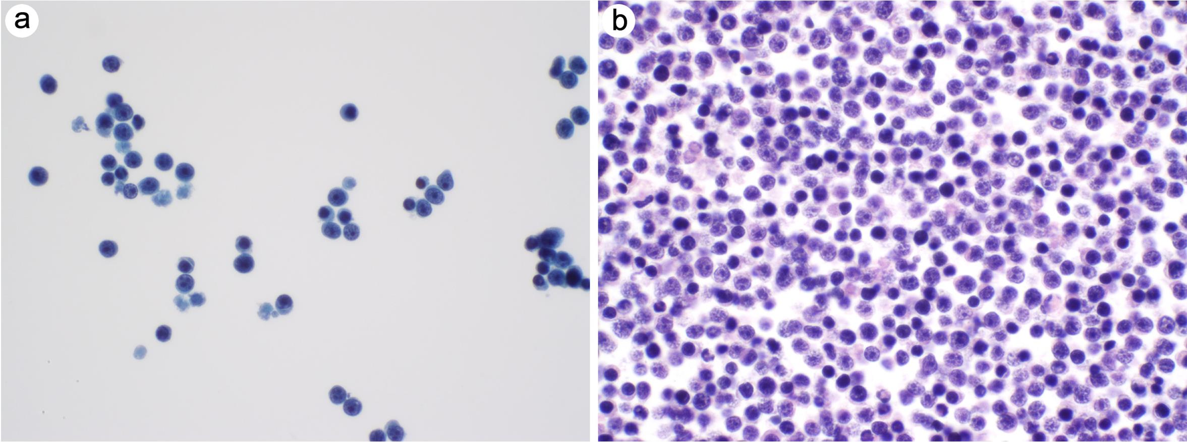 Non-Hodgkin B cell lymphoma.