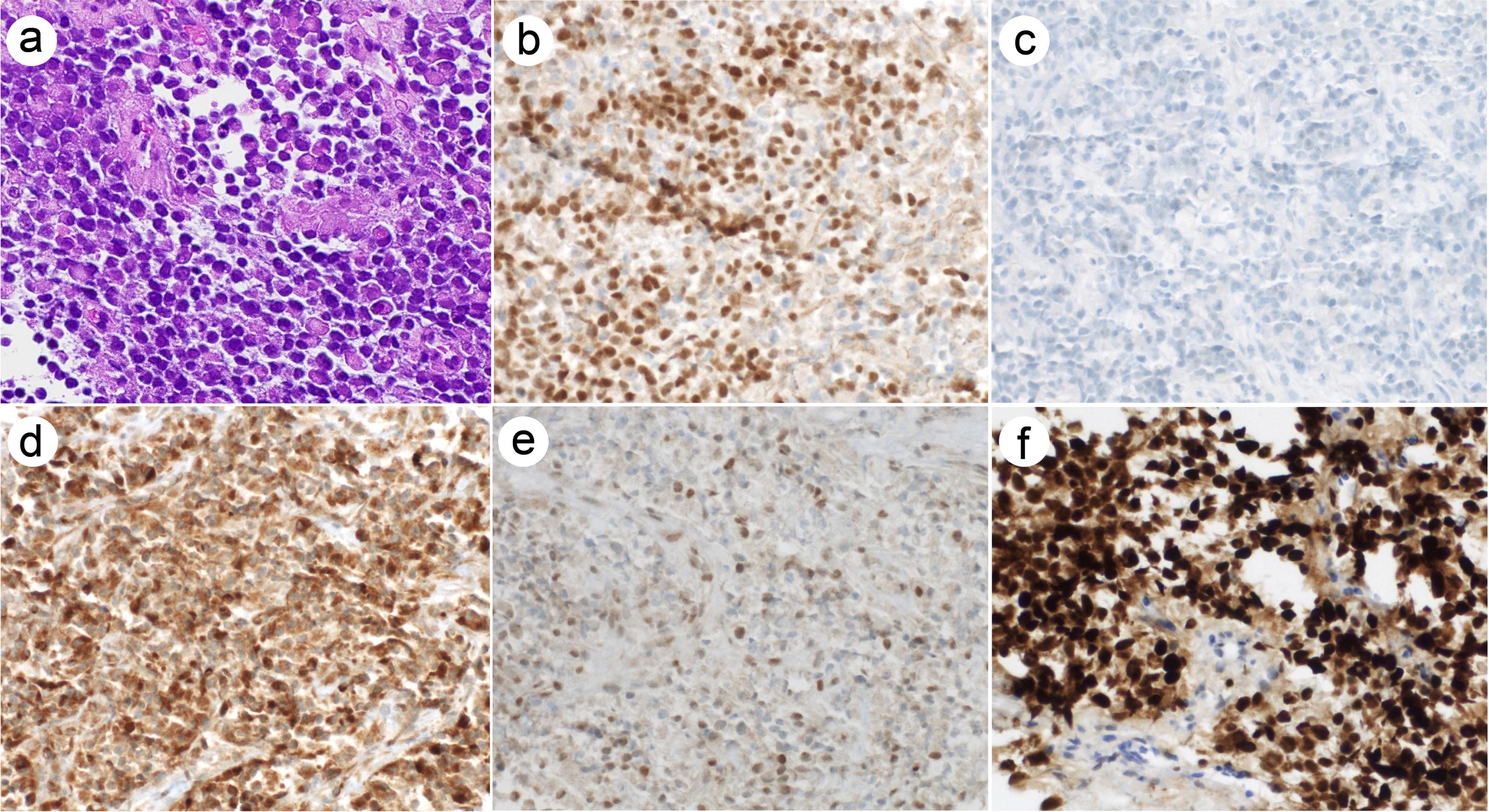 RMS in the initial supraclavicular lymph node biopsy mimicking B lymphoblastic lymphoma.