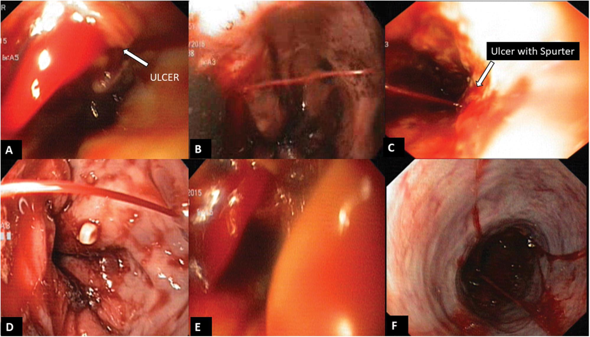 Type A ulcer with spurting. (A, B) With EVL bands. (C–F) Without EVL bands.