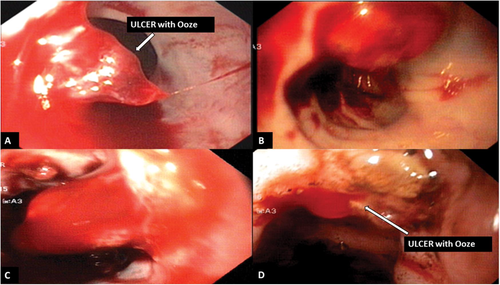 Type B ulcer with ooze. Bleeding can be noted (A, B) with EVL bands <italic>in situ</italic>, and (C, D) without EVL bands.