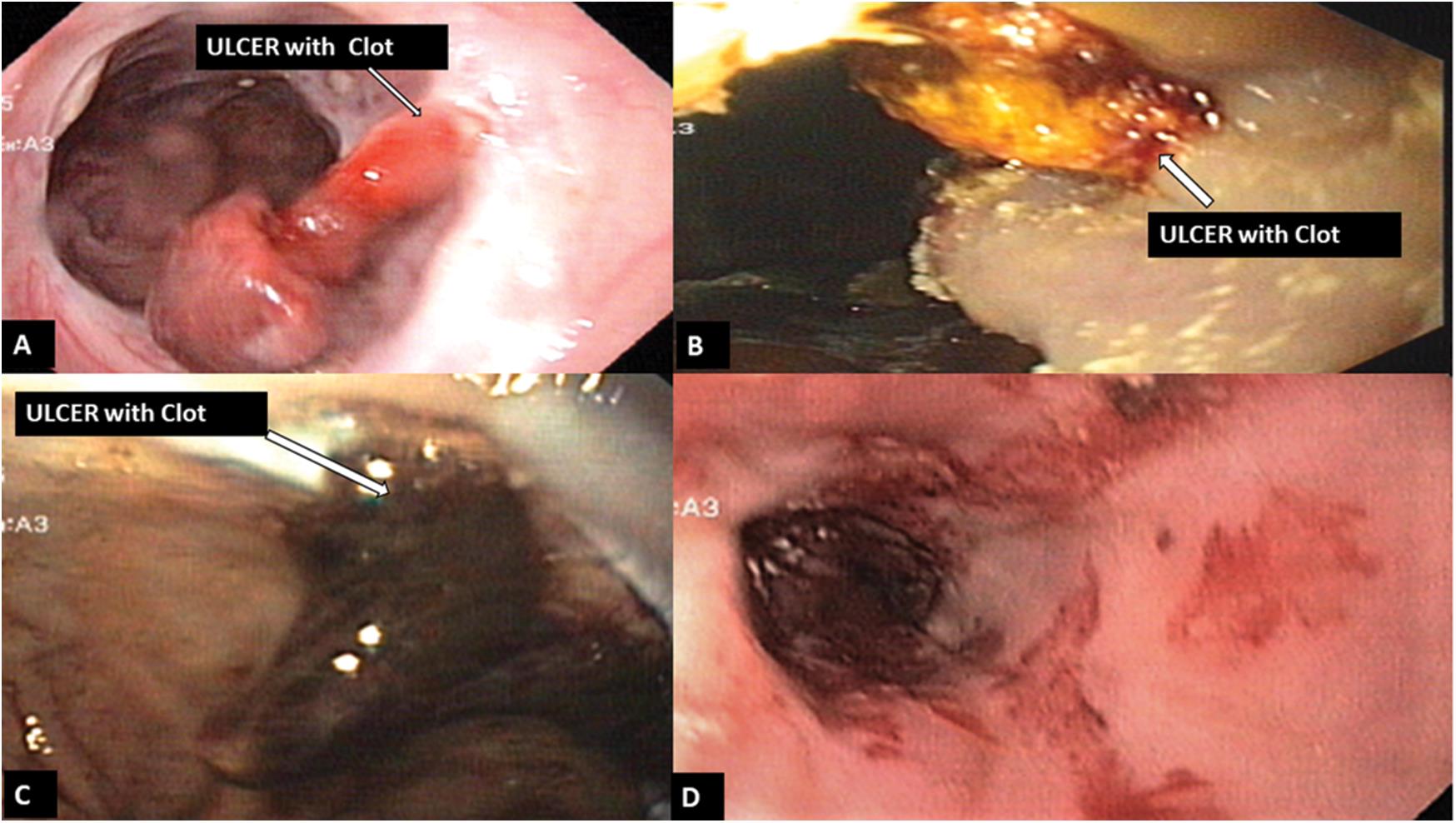Type C ulcer with visible clots, scab or exudates from the ulcer without any bleeding.