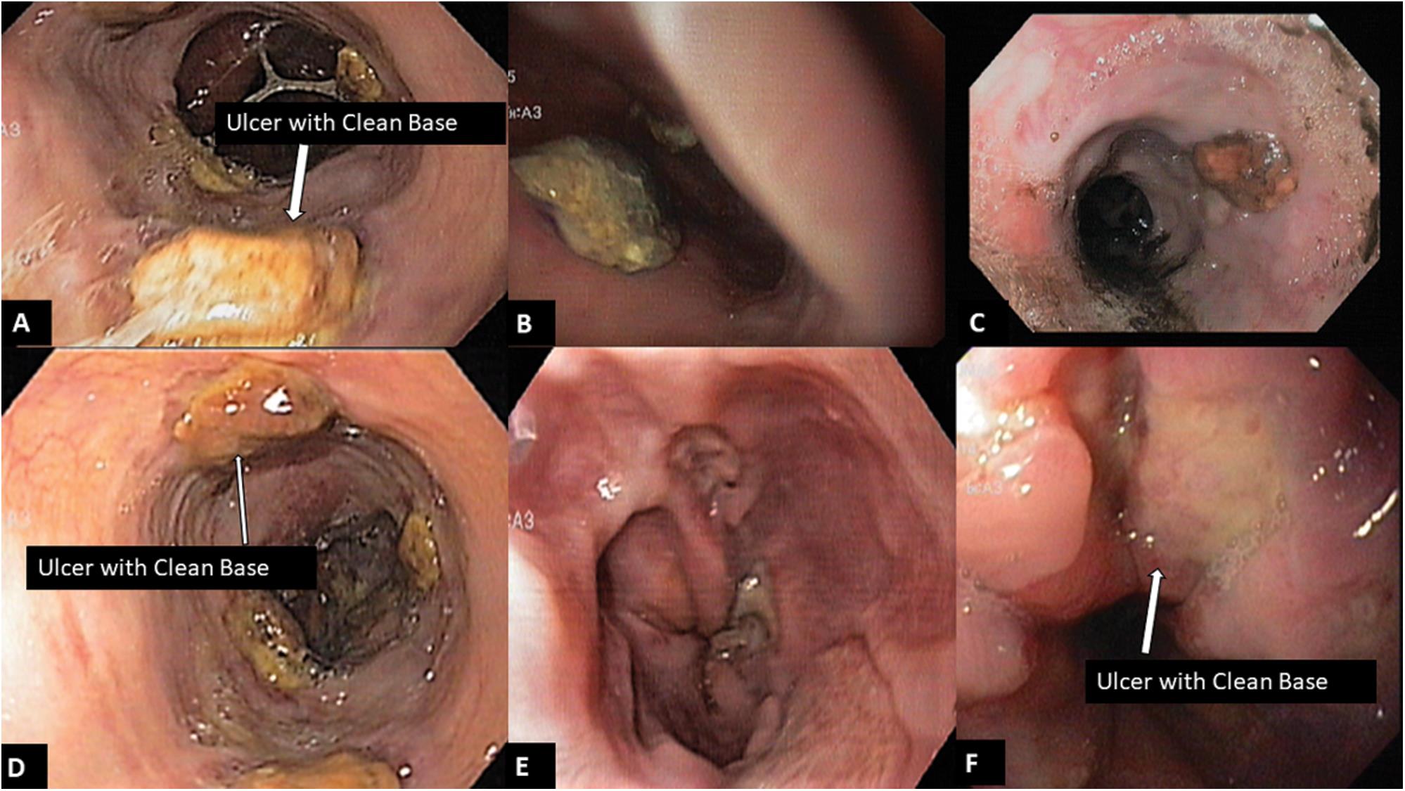 Type D ulcer with pigmented or clear base.