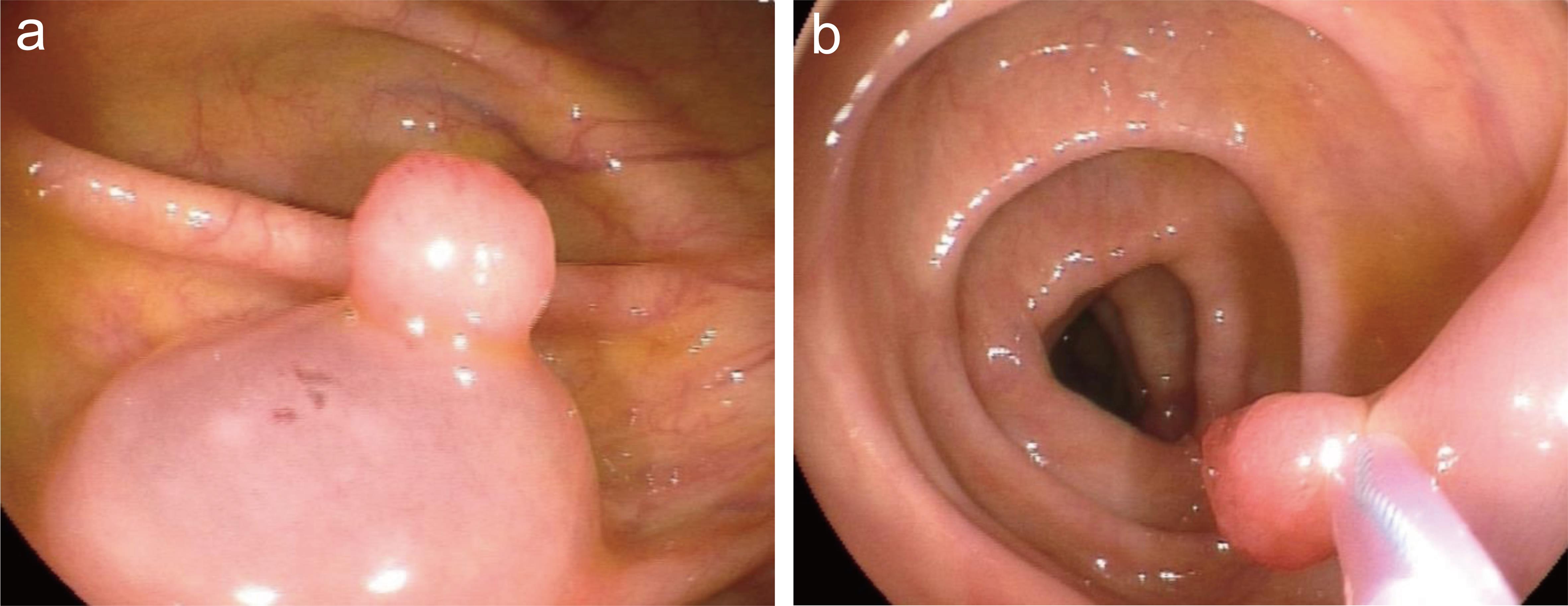 Colonoscopic removal of polyps by endoscopic mucosal resection in the ascending colon and transverse colon.