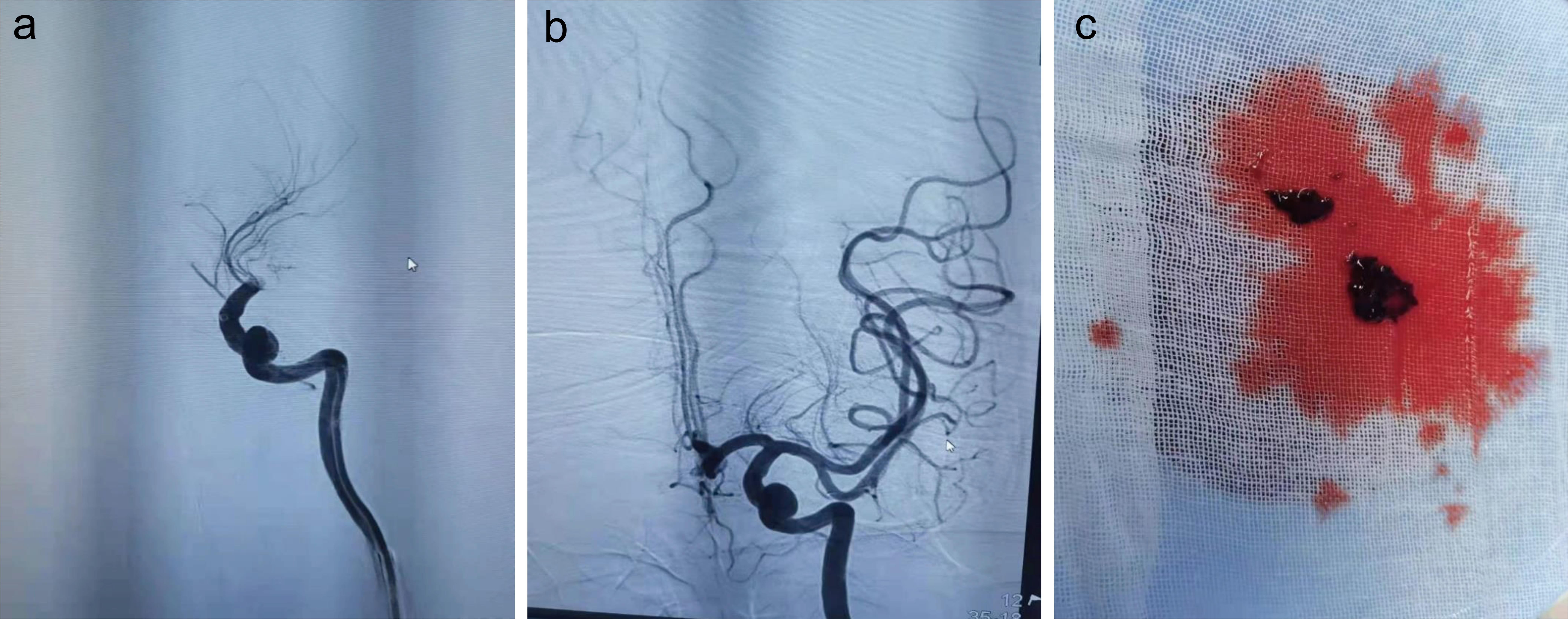 Emergency cerebral angiography and stent retriever thrombectomy at the end of the left internal carotid artery.