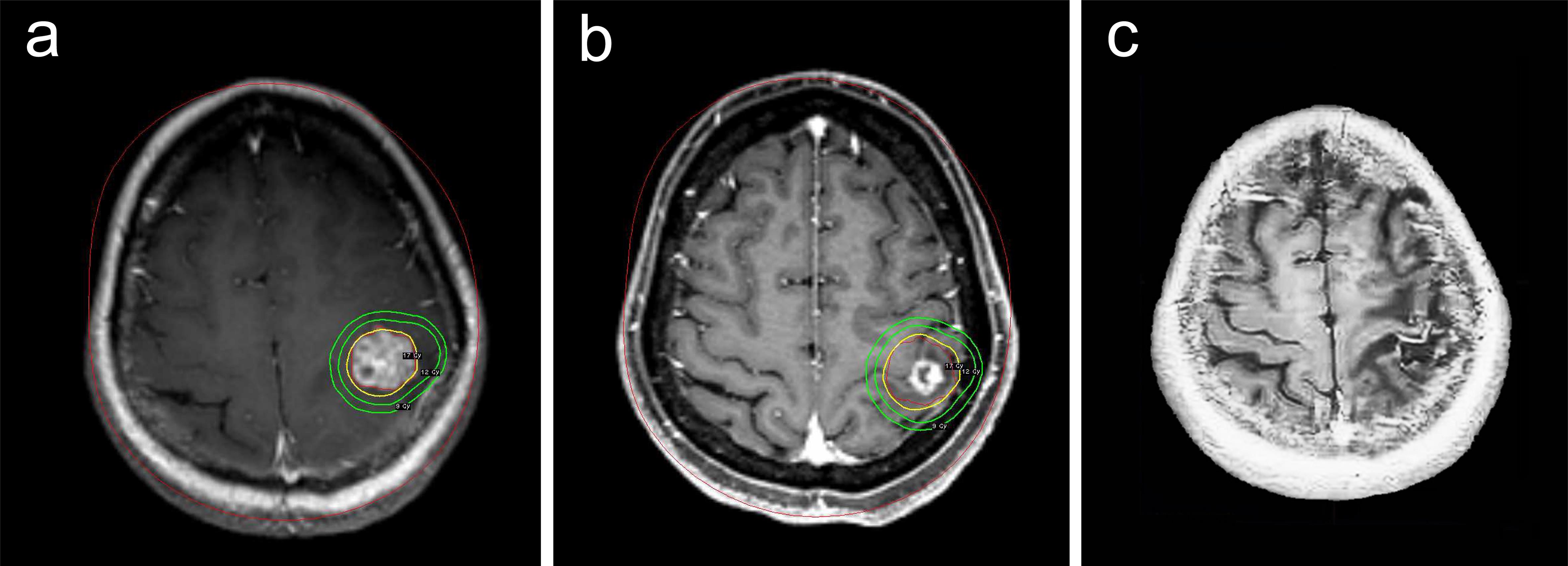 Axial-loaded MRI of a 52-year-old female patient with right limb weakness.