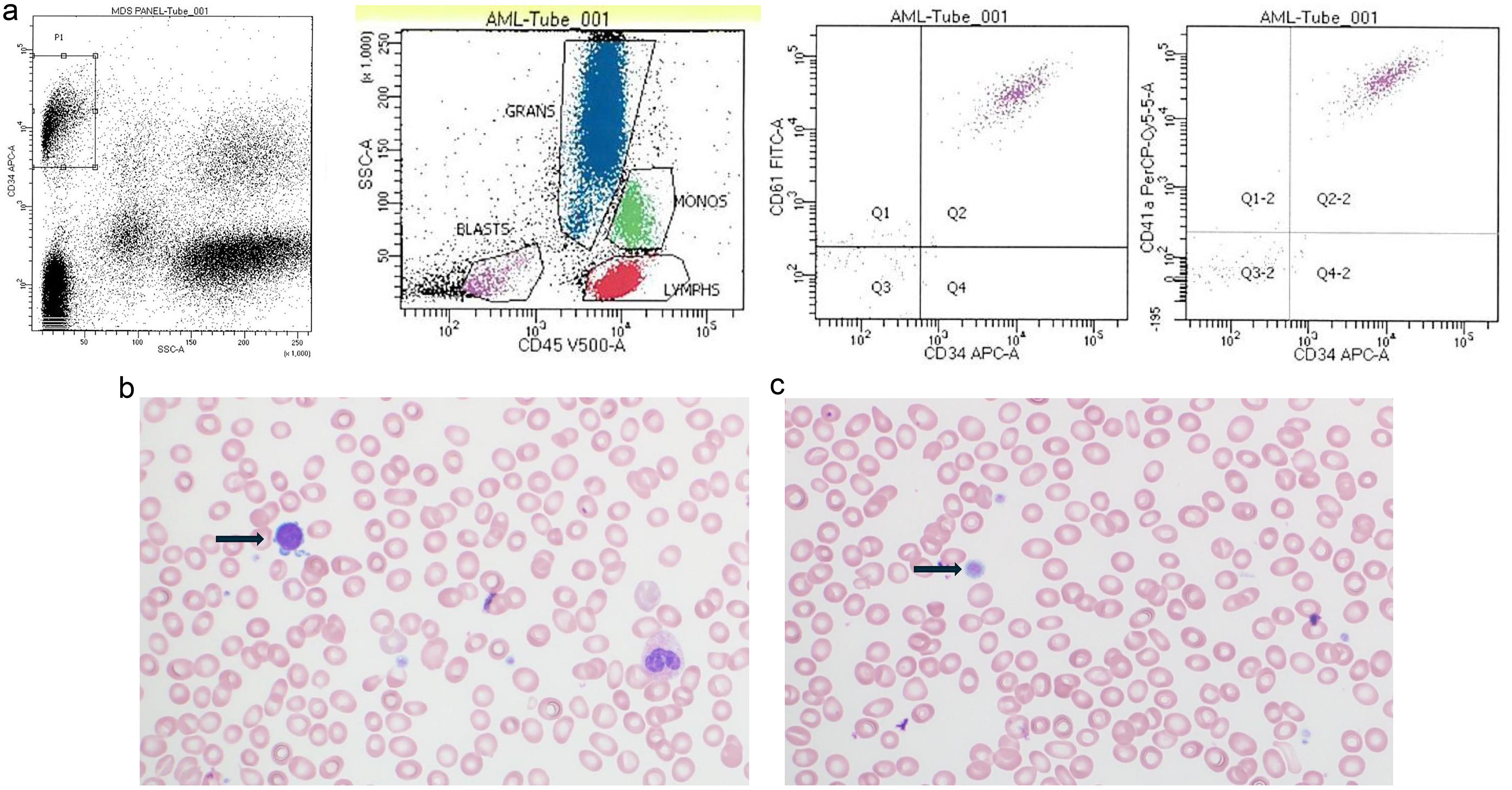Flow cytometry analysis of peripheral blood (a) in 2020 showed that the events with characteristics of blasts were positive for CD34, CD61, and CD41a. Peripheral blood smear showed circulating micromegakaryocytes (designated by arrow in b) and giant platelets (designated by arrow in c). (b and c: Wright-Giemsa, 600×).
