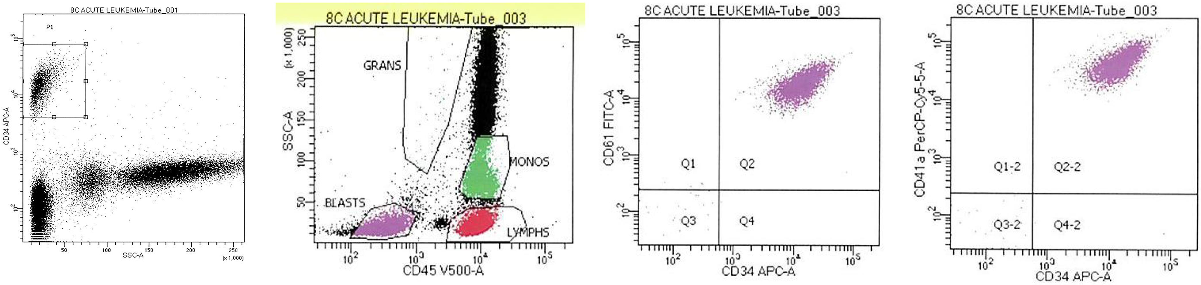 Flow cytometry analysis of peripheral blood in 2024 showed the same population of CD34<sup>+</sup> cells, also positive for CD61 and CD41a.
