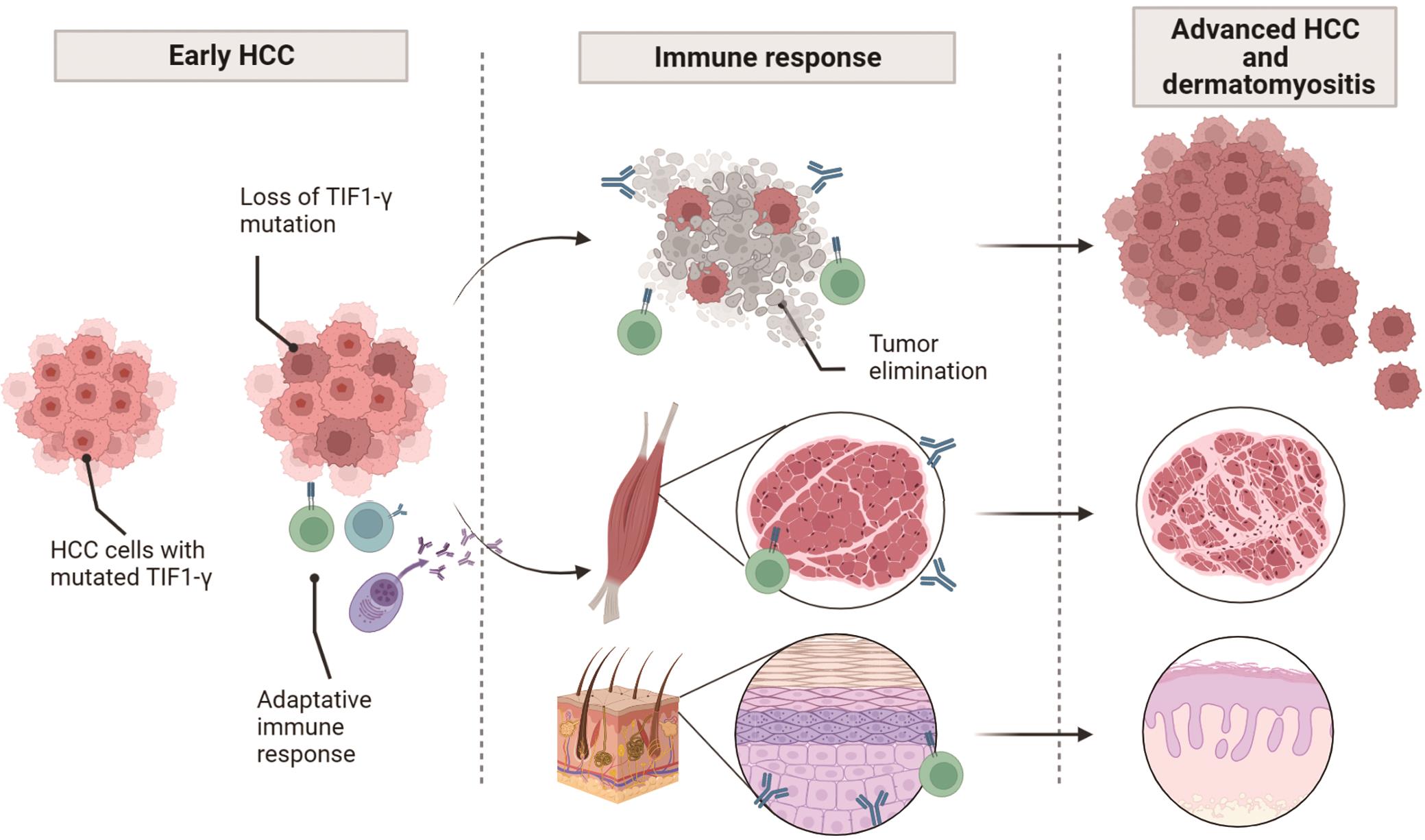 Hypothetical mechanisms of the pathogenesis that underlie the association between HCC and TIF1-γ-positive DM.