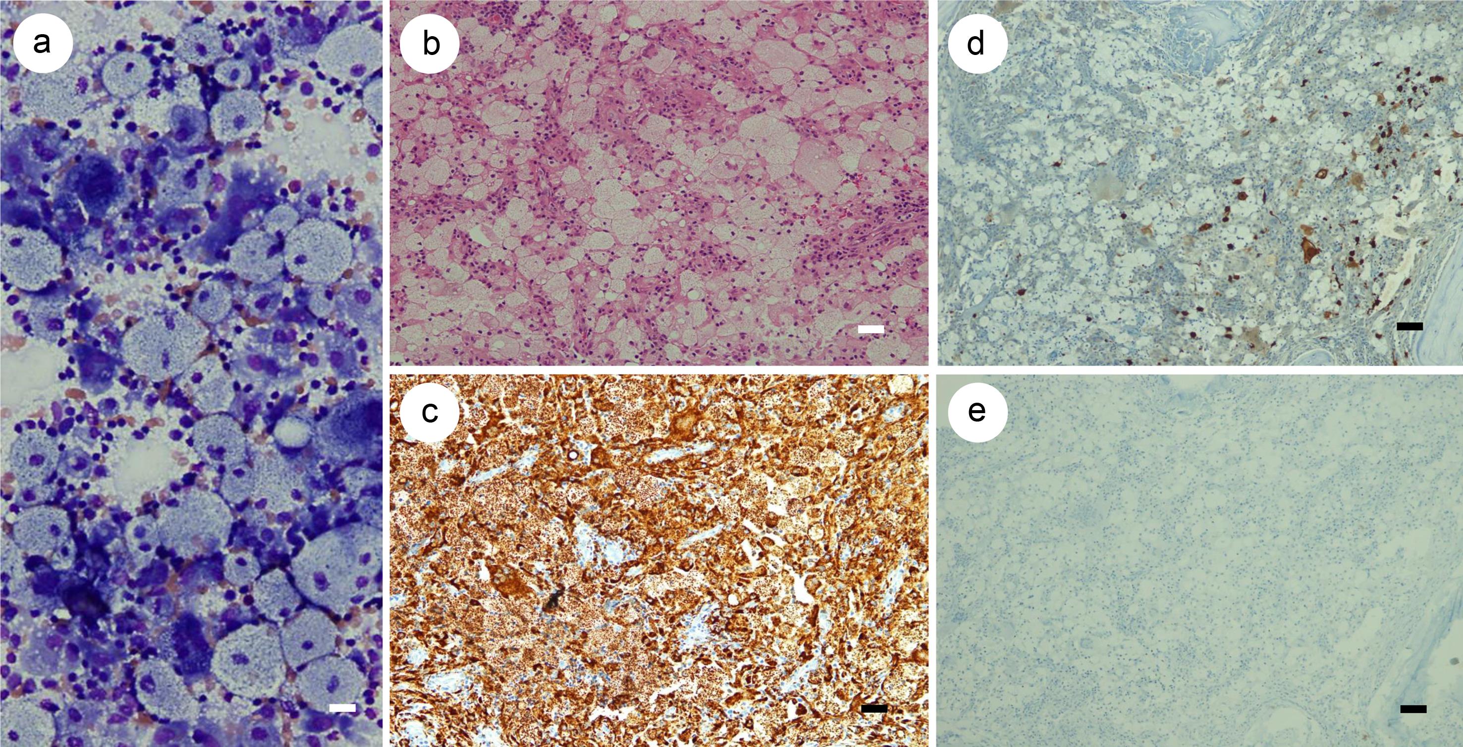 Histopathology of the biopsied bone marrow tissue shows; touch preparation (May-Giemsa stain, original magnification x1,000) (a) and embedded tissue- H&E stain (×200) (b), CD68 stain (×200) (c), S100 stain (×200) (d) and CD1a stain (×200) (e).
