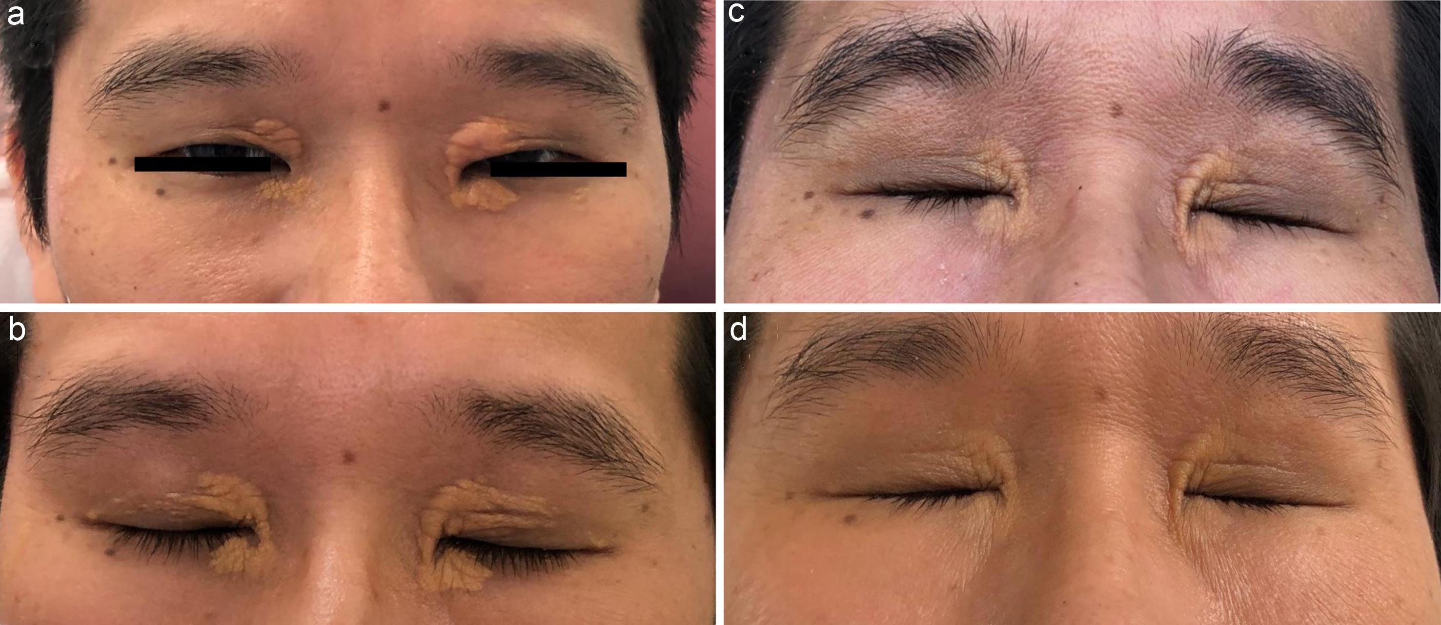 Features of xanthelasma palpebrarum (XP): exacerbated lesions during infliximab treatment (a), no improvement with the Special C regimen (b), partial improvement after a MEK inhibitor (c), and marked improvement after combined BRAF/MEK inhibitors (d).