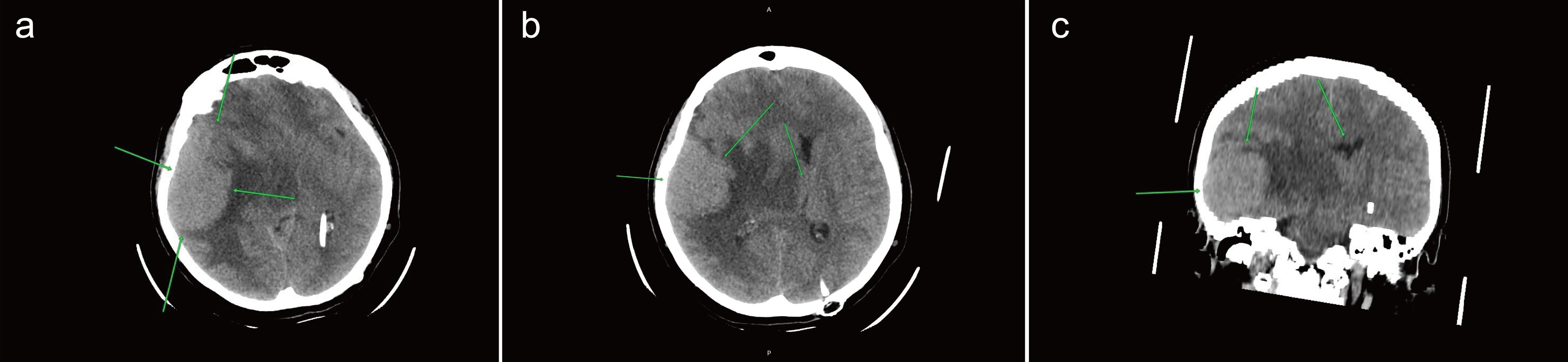 Space-occupying lesion in the right temporal lobe parenchyma.