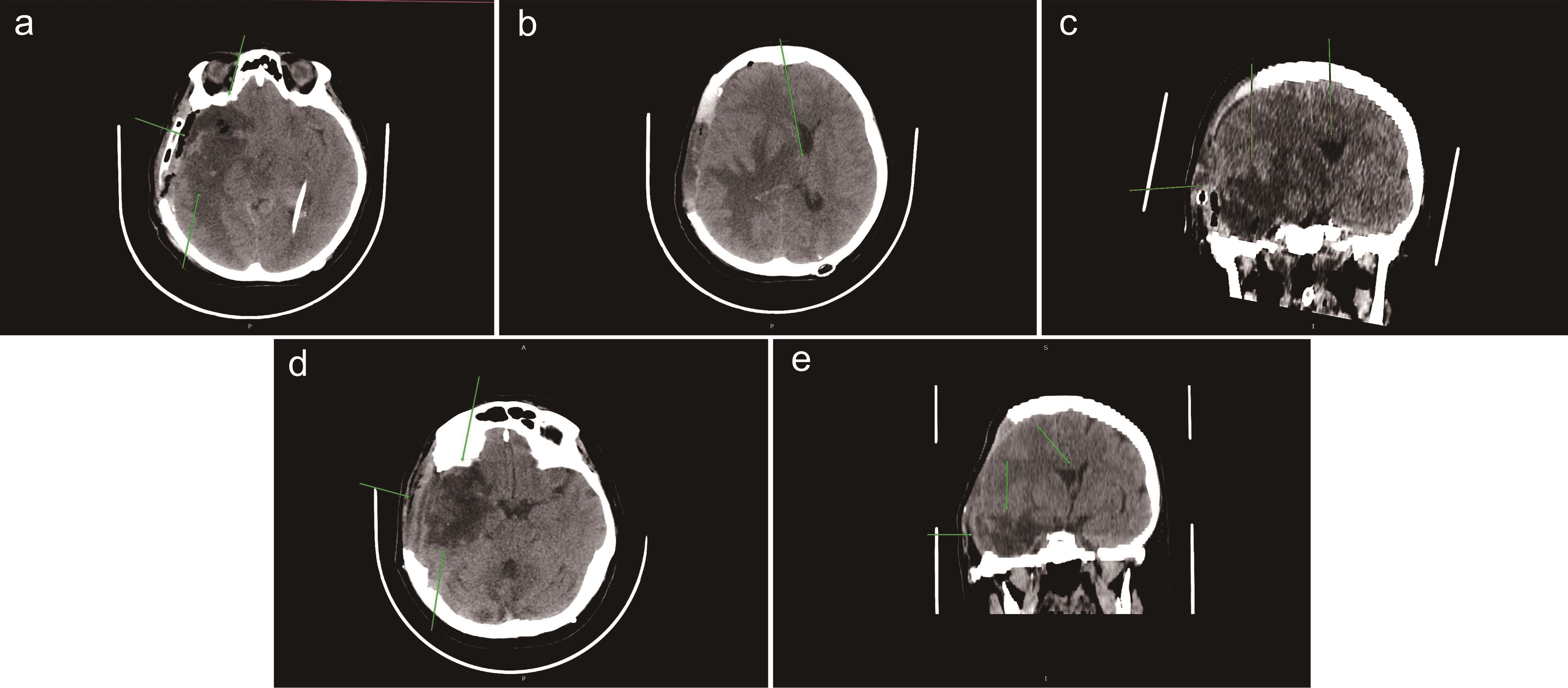Postoperative state after decompressive craniectomy in the right temporal region and removal of a space-occupying lesion in the right temporal lobe parenchyma (a) (February 6, 2022).