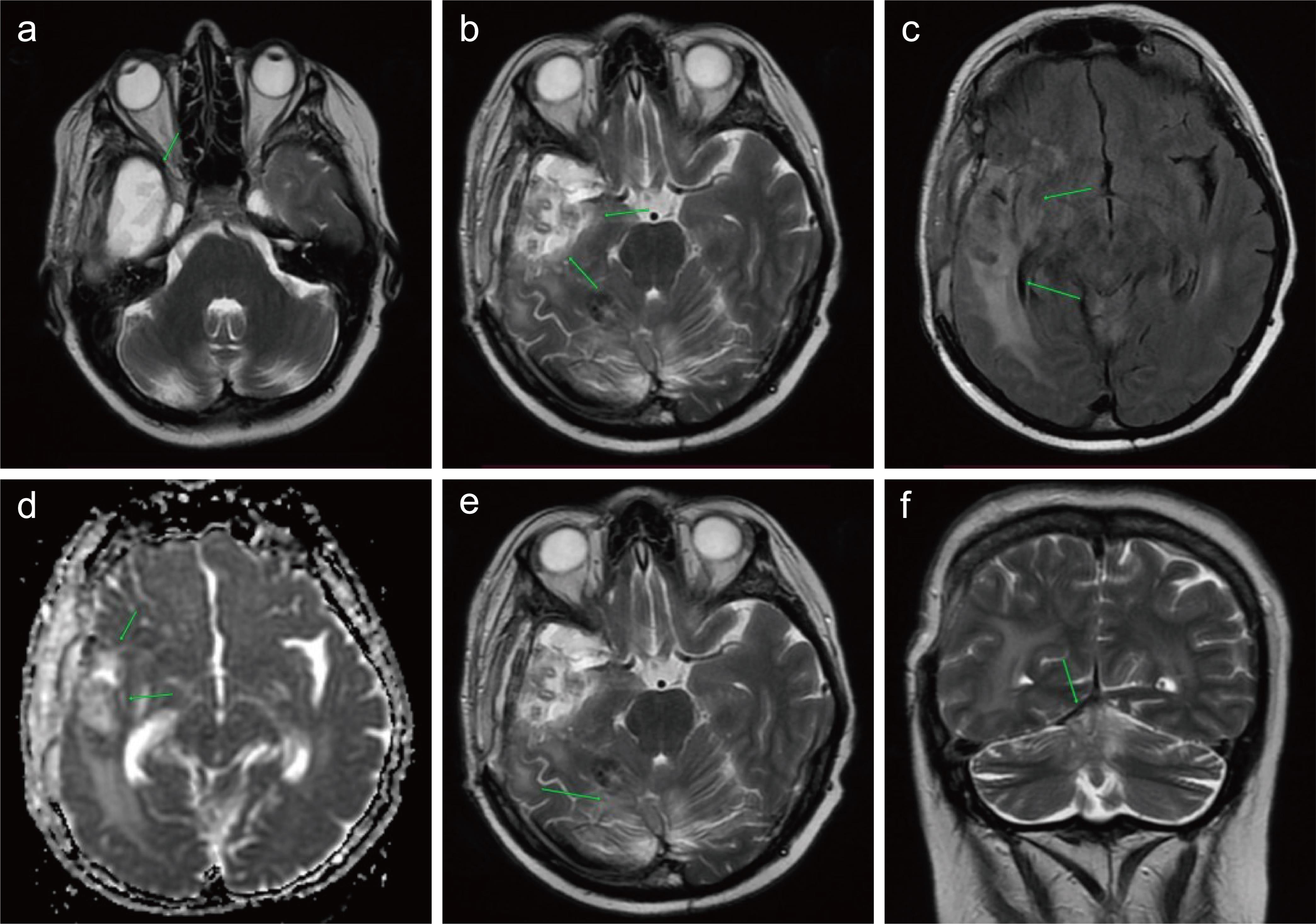 Postoperative state after tumor resection in the right temporal lobe (March 5, 2022).