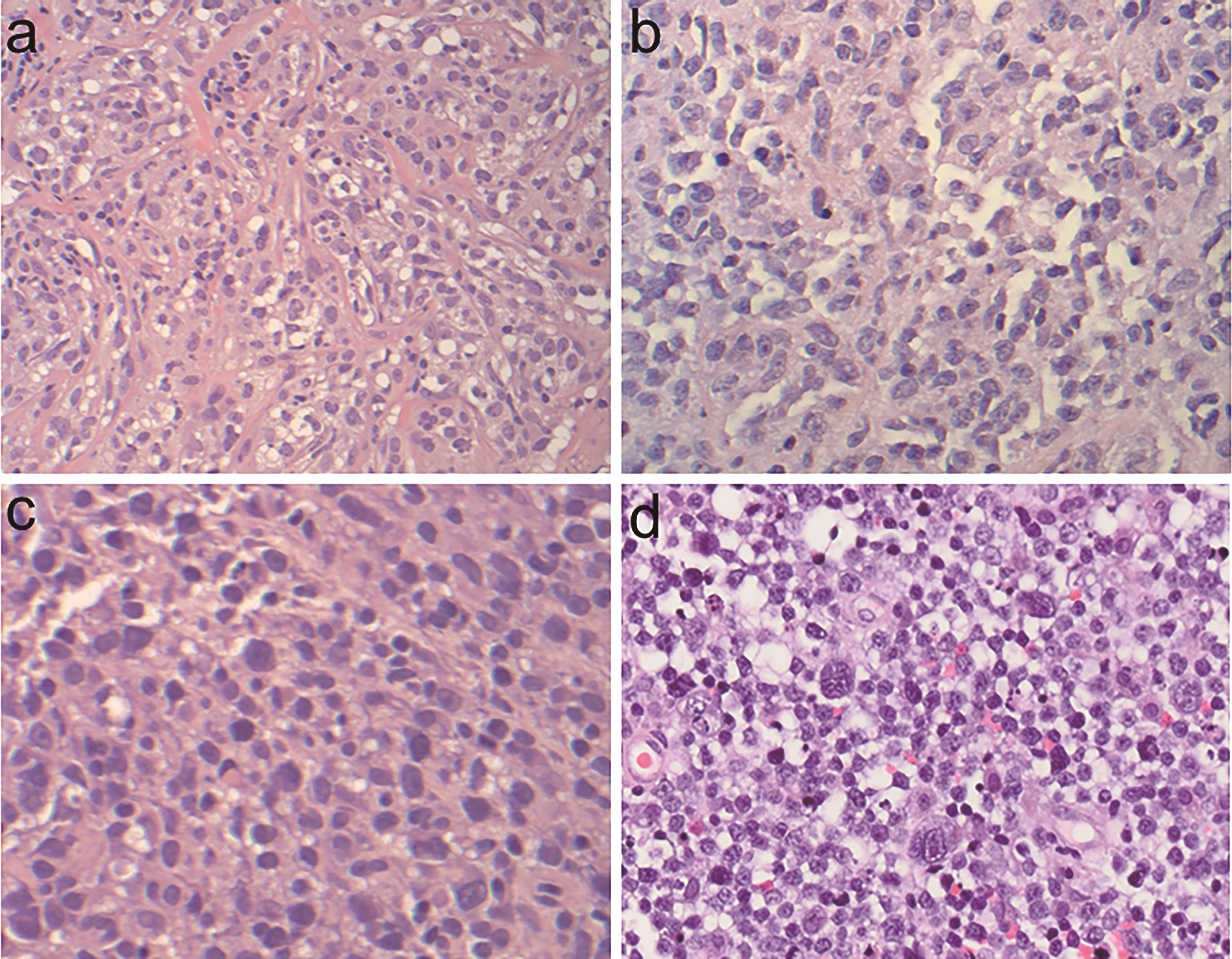 Representative cases of PMBL with variable morphologic features