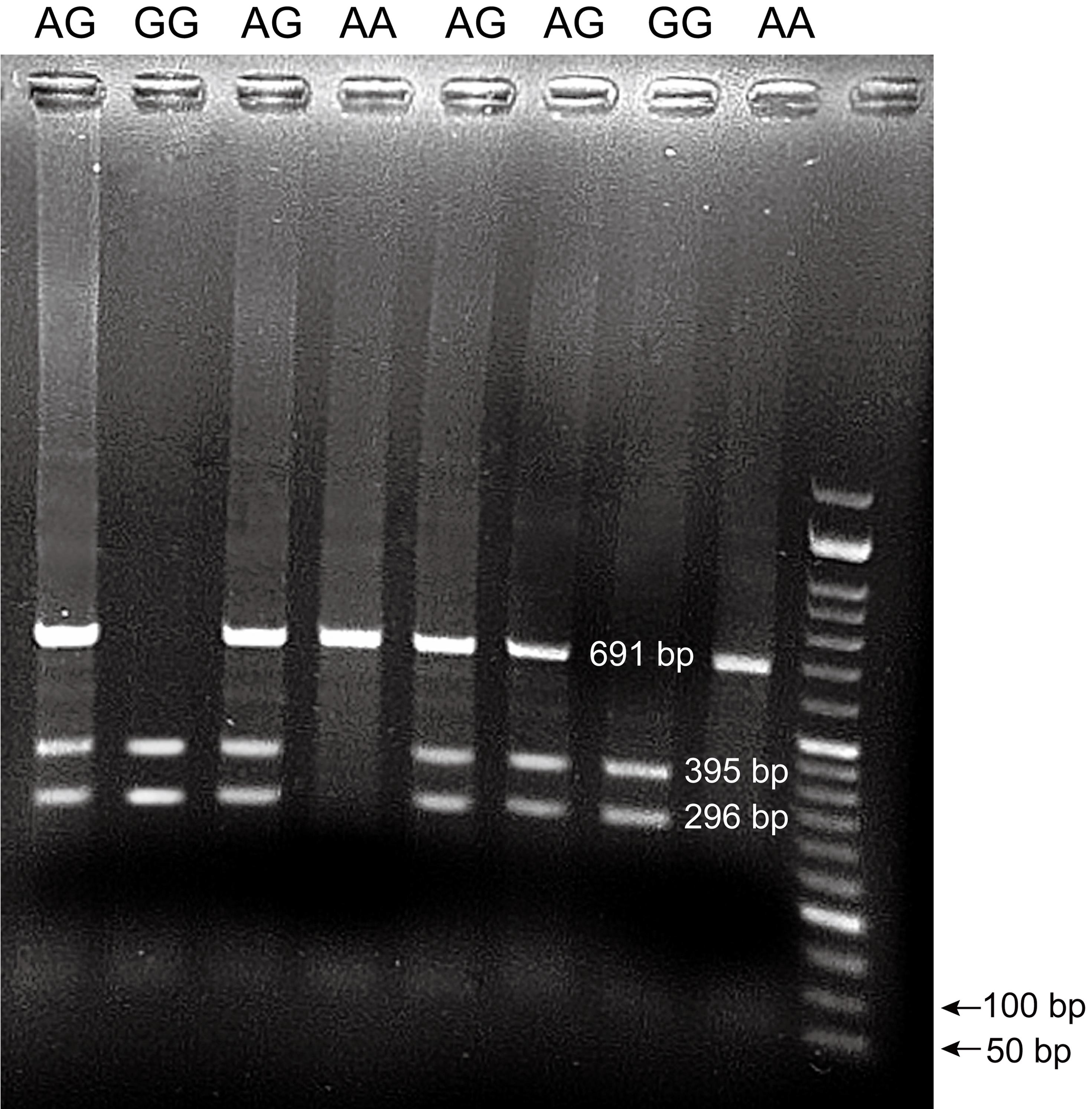 IL-27p28 (rs153109A>G) PCR product after digestion with XhoΙ enzyme.