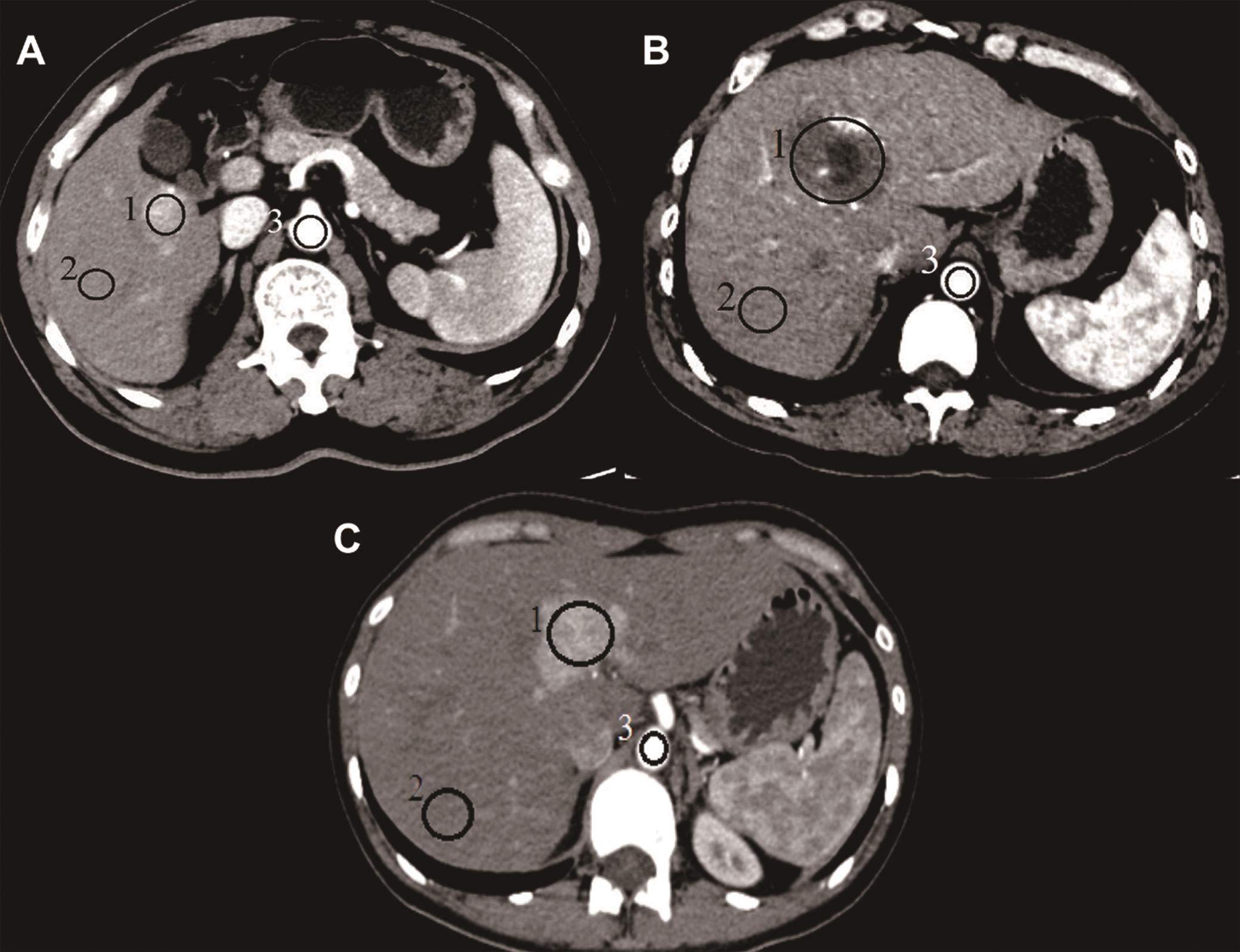 Differentiation of Hepatocellular Carcinoma from Hepatic Hemangioma and