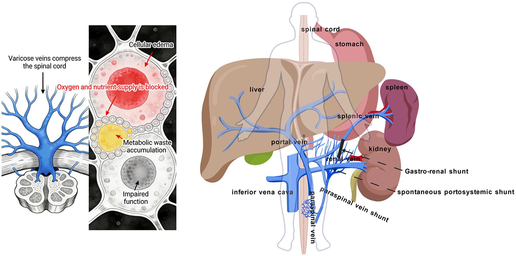 Schematic illustration of the proposed pathogenic mechanism in HM.