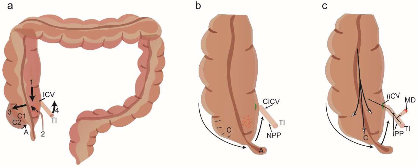 Colonic anatomy and pathophysiology of left colonic partial functional obstruction.