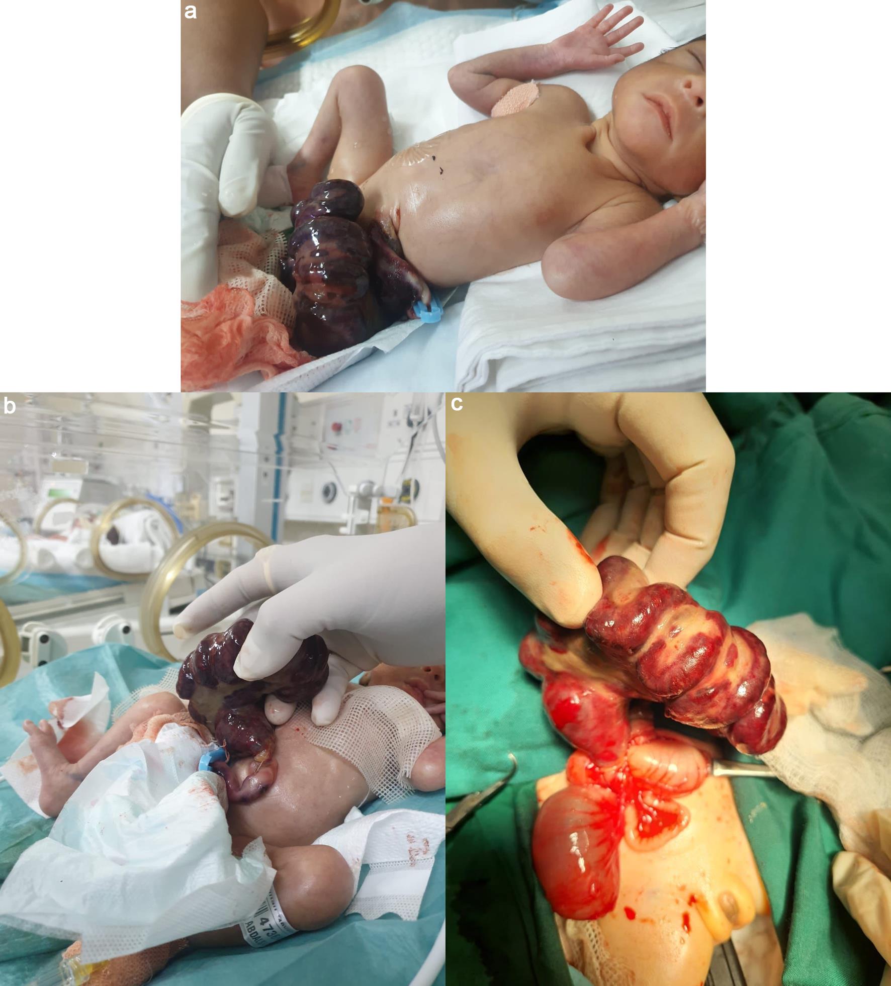 Giant closing midgut gastroschisis.