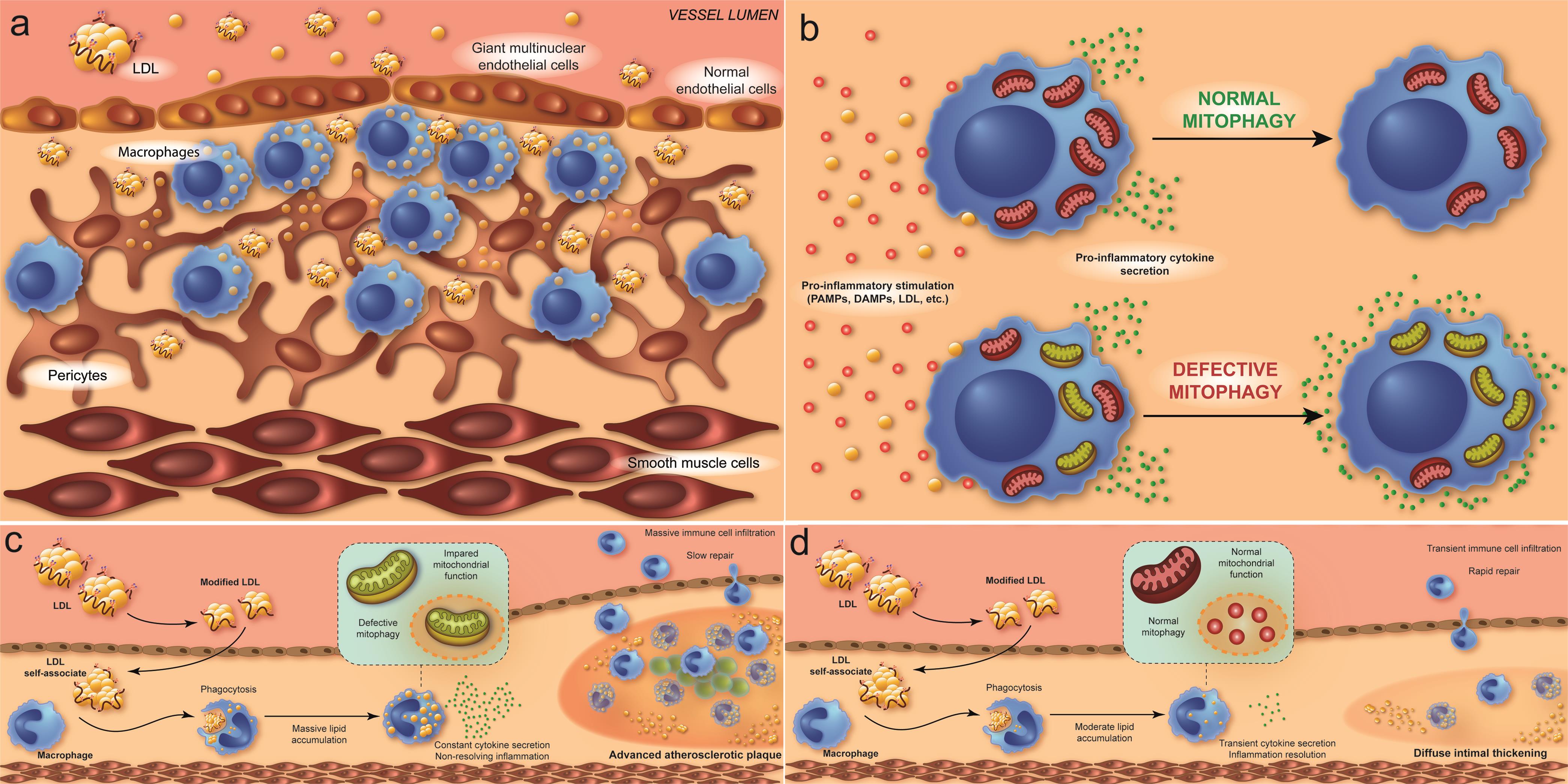 Proposed mechanisms of chronic inflammation development in the arterial wall during atherogenesis and atherosclerotic lesion formation, which is associated with defective mitophagy due to mtDNA mutations.