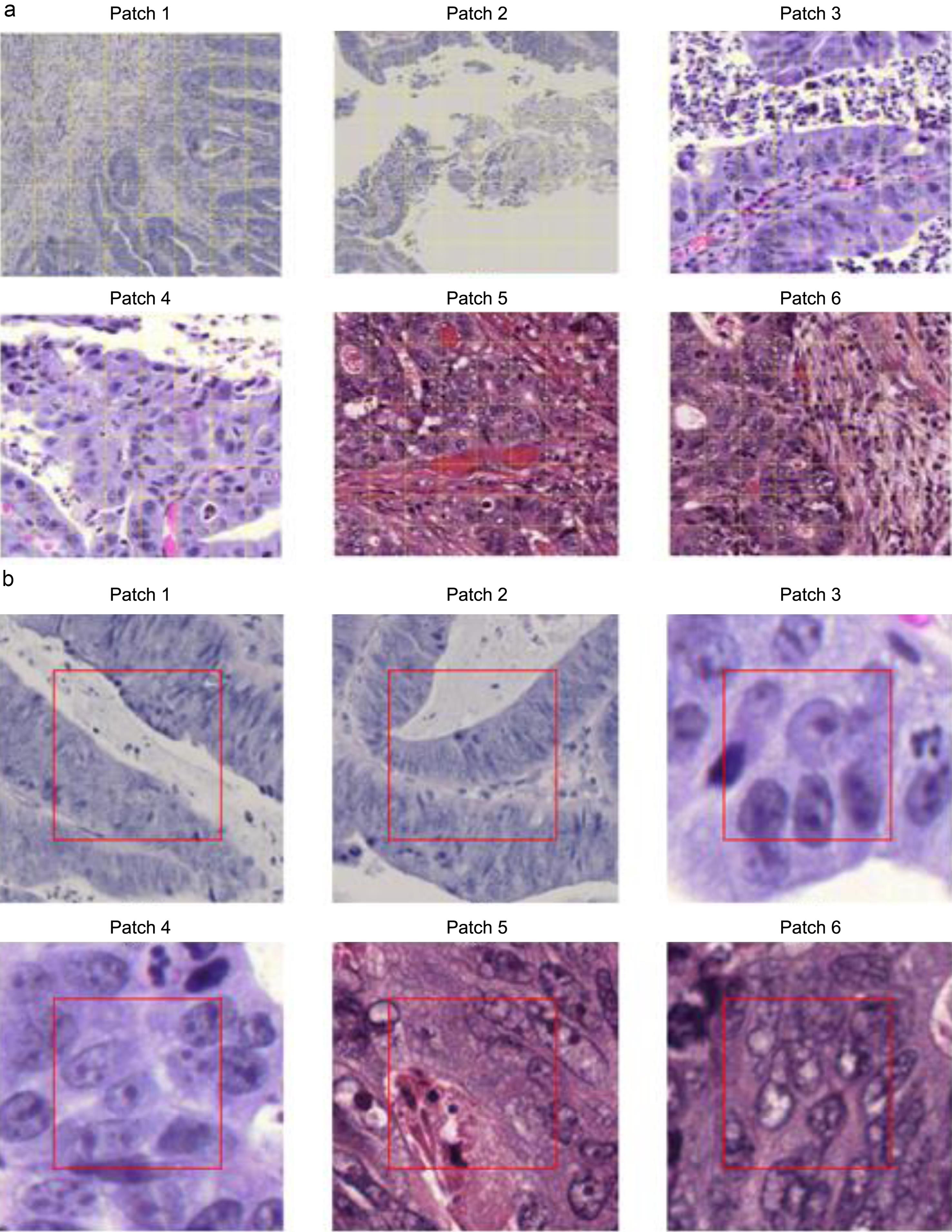 Whole Slide Image (WSI) preprocessing and patch extraction for rectal cancer lesions.