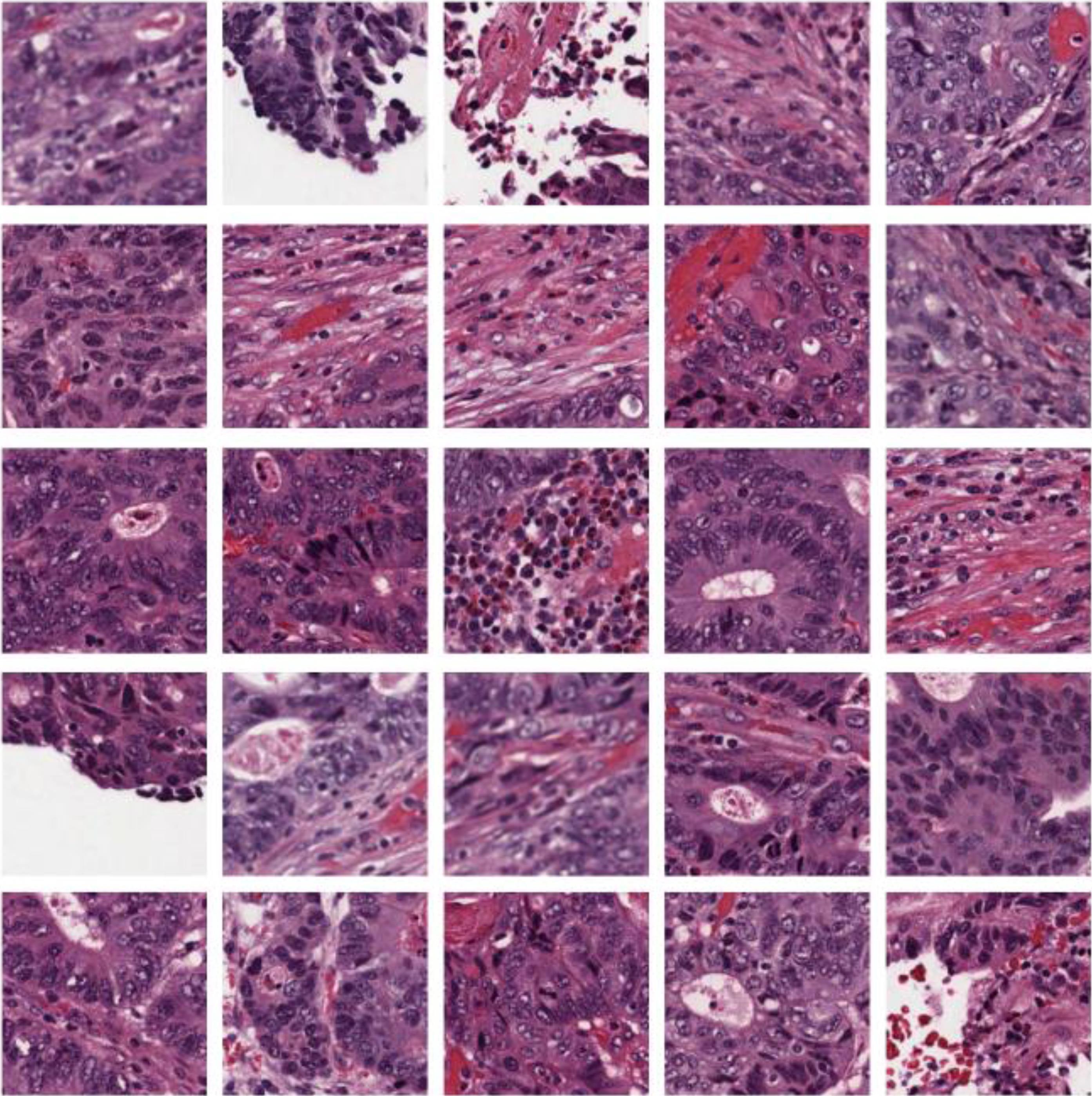 Representative 5×5 grid of extracted 512×512 px patches from precancerous and malignant rectal lesions.