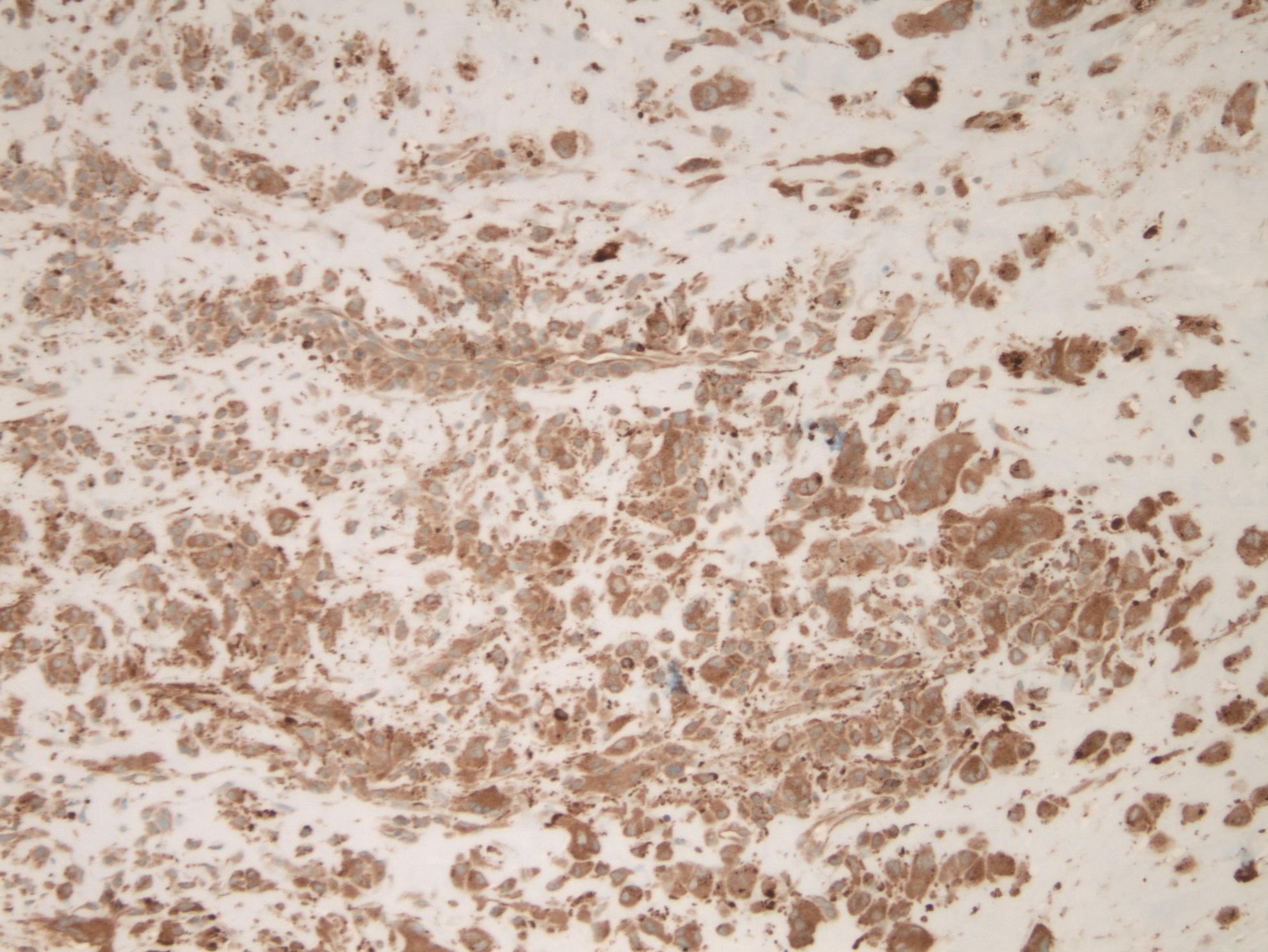 Immunohistochemical stain of CD 68.