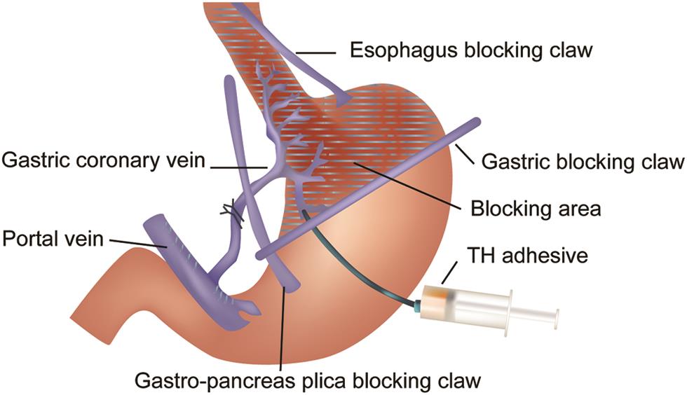 Schematic diagram of gastric venous embolization with TH glue.