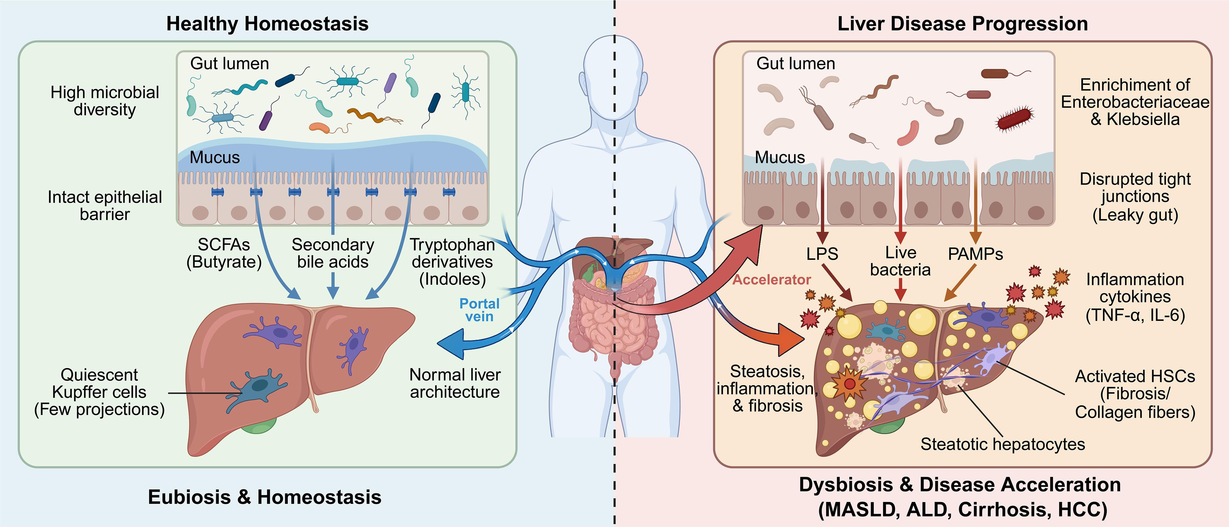 The Gut–liver axis: Dysbiosis as an accelerator of liver disease progression.