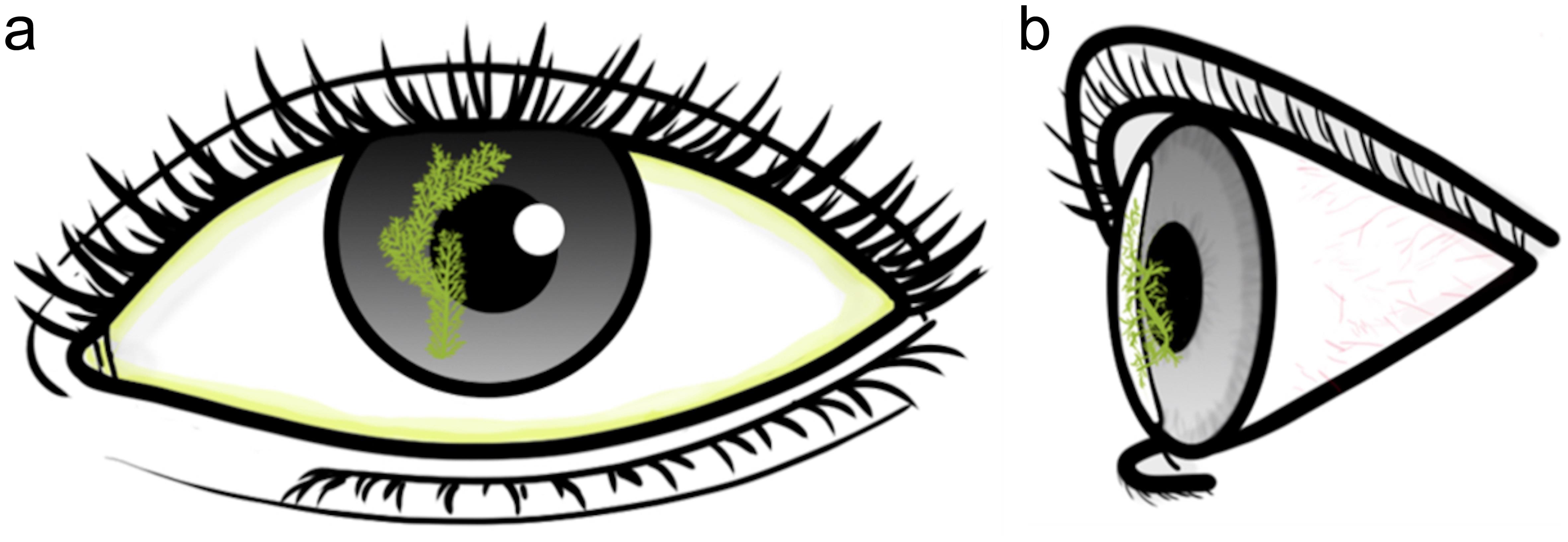 Schematic drawing of an eye with a typical dendritic ulcer on the cornea, resembling branches of a tree with the greenish-yellow color of fluorescent eye drops.