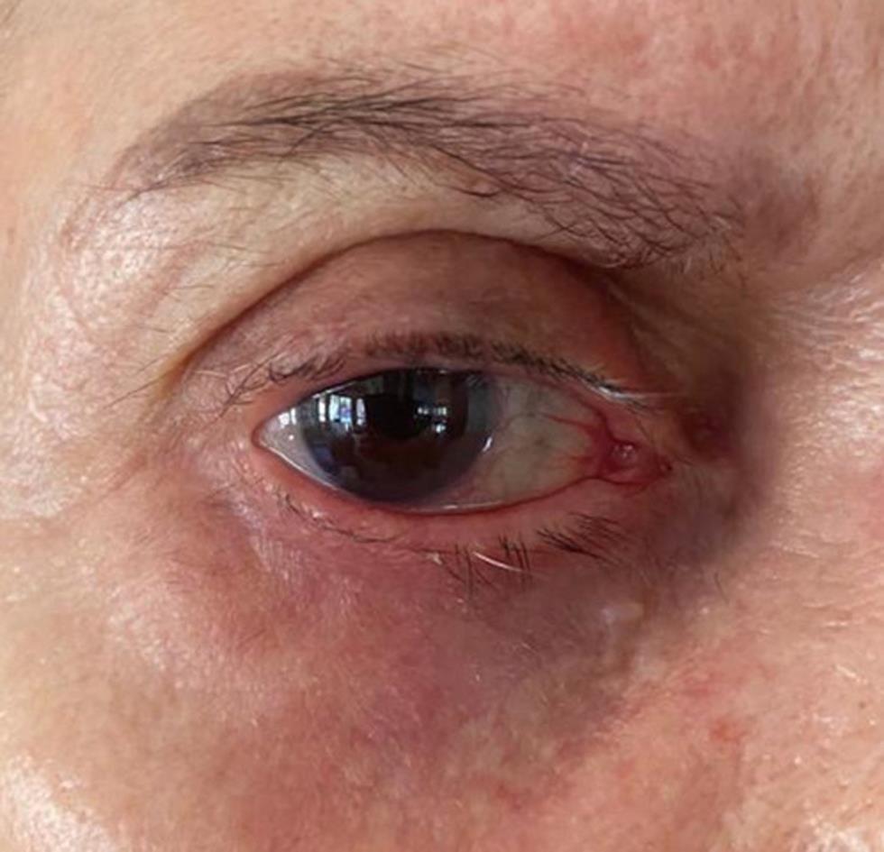 Patient’s left eye with full resolution of keratitis.