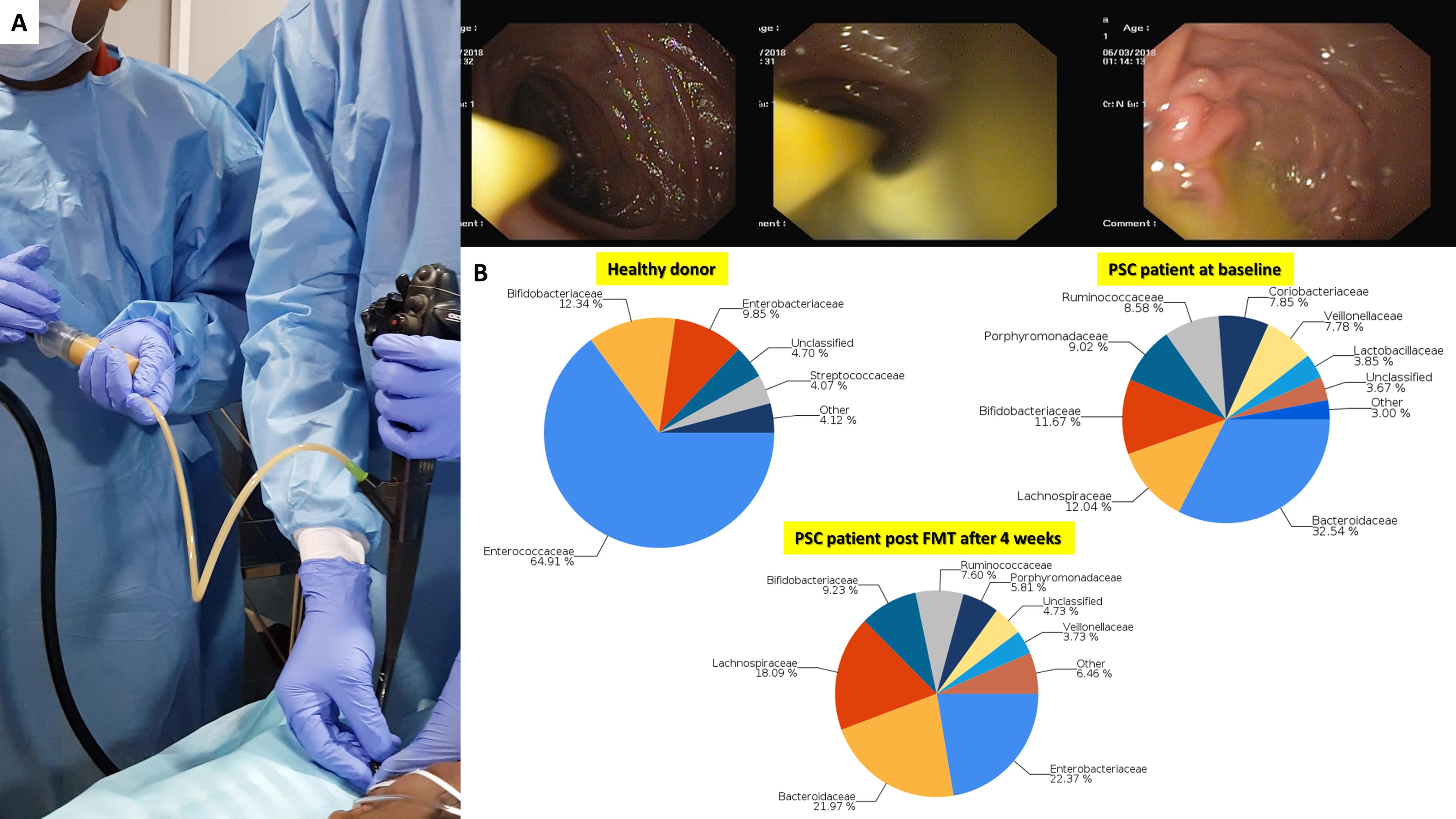Healthy donor microbiota restitution therapy through upper gastrointestinal endoscopy.