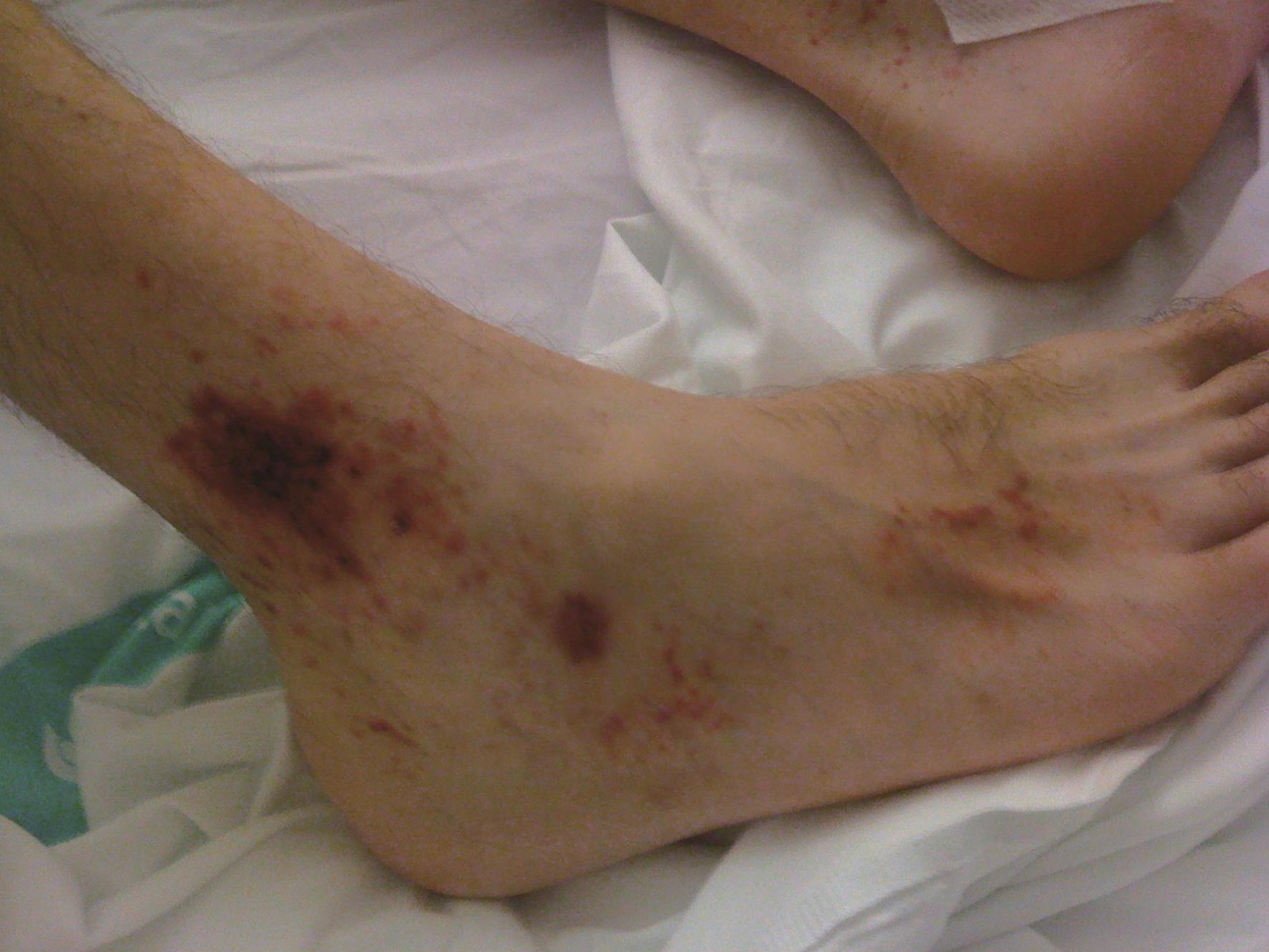 Leukocytoclastic vasculitis in the external area of the distal third of the right leg and foot.