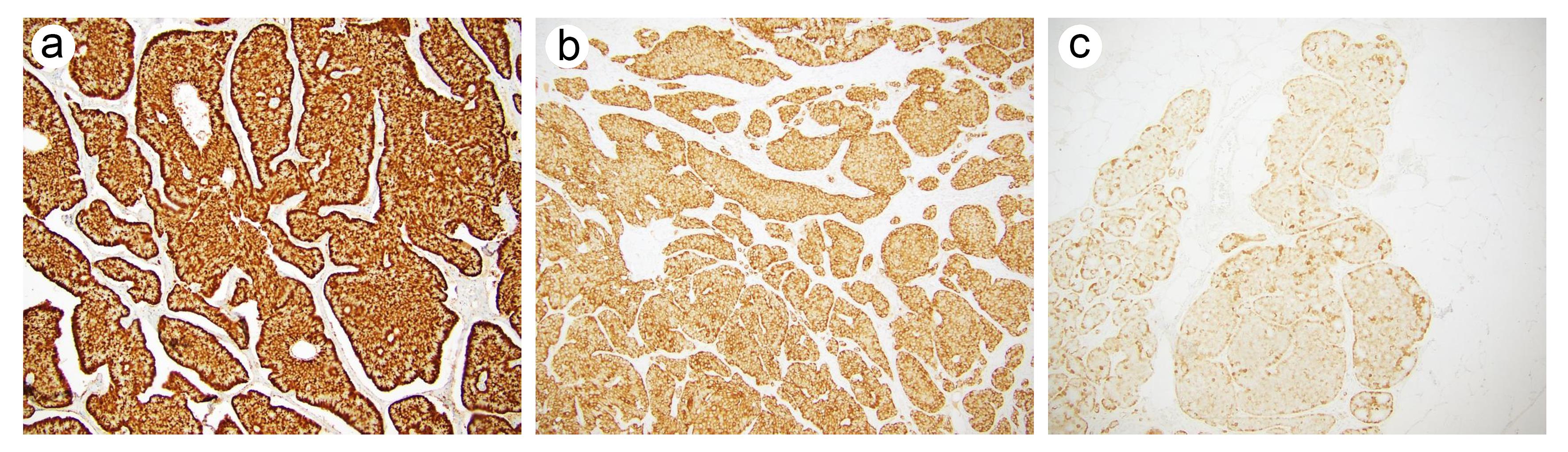 Examples of CXCR2 expression (original magnification ×100).