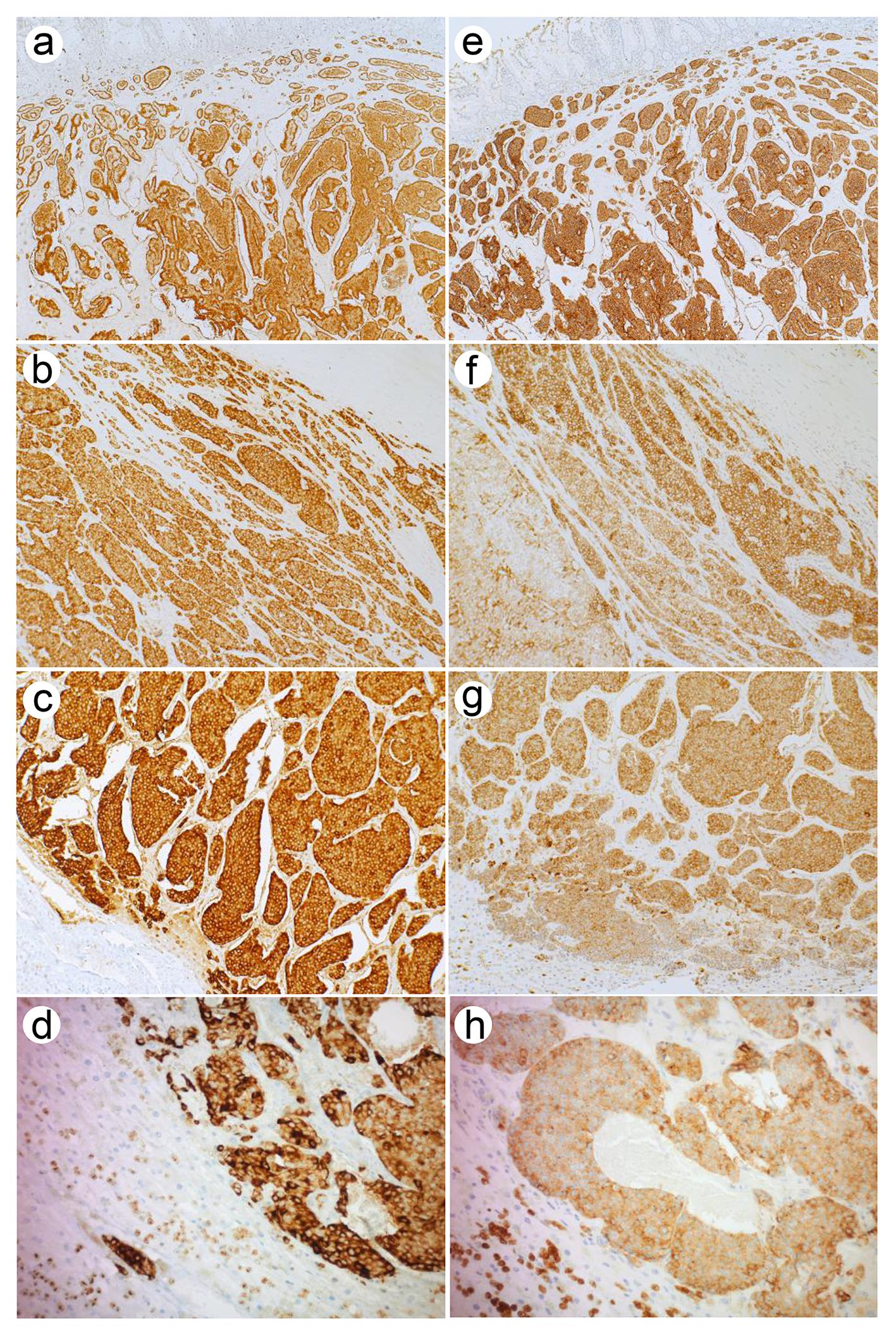 An example of a small intestinal neuroendocrine tumor.