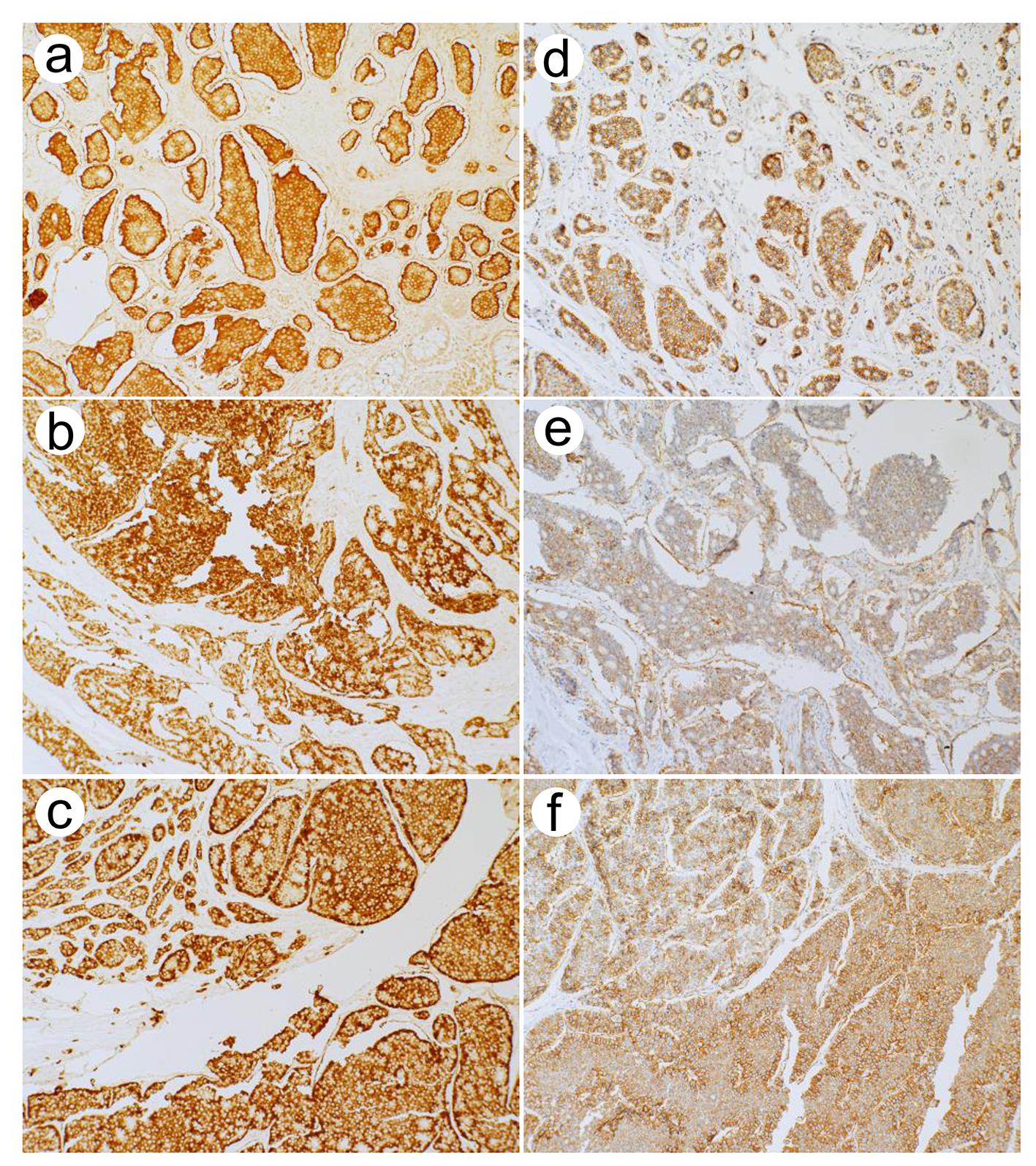 Another example of a small intestinal neuroendocrine tumor (original magnification ×100).