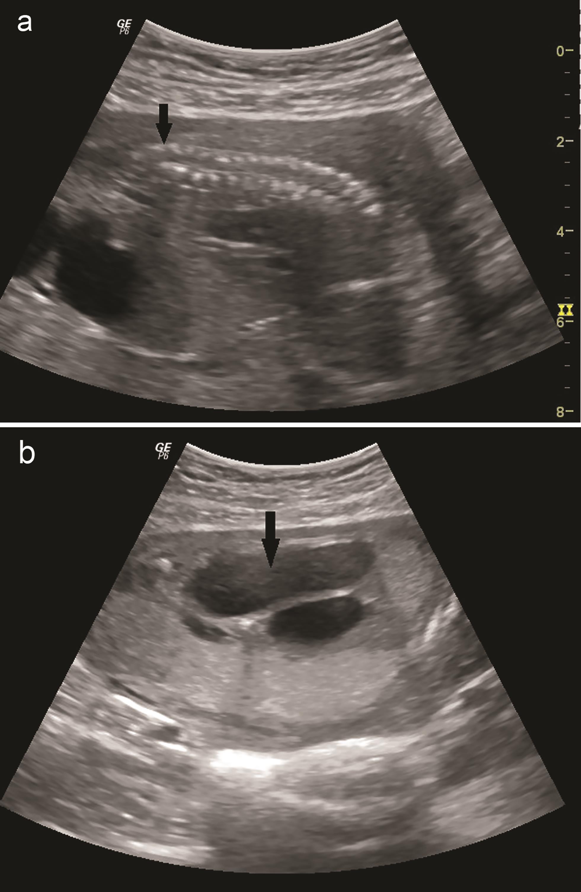 A 28-year-old female at 26 weeks of gestation 26.