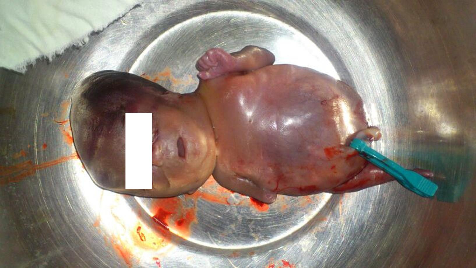 Image of stillborn showing a single hypoplastic lower limb, hypoplastic right upper limb and absent external genitalia.