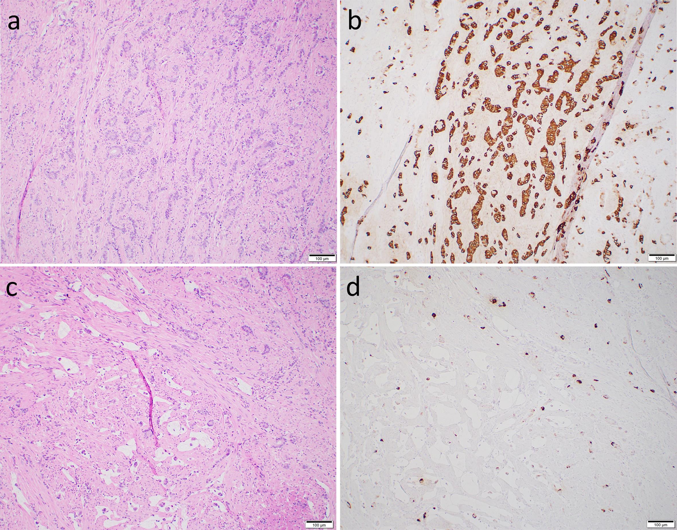 Chromogranin staining in goblet cell adenocarcinoma.