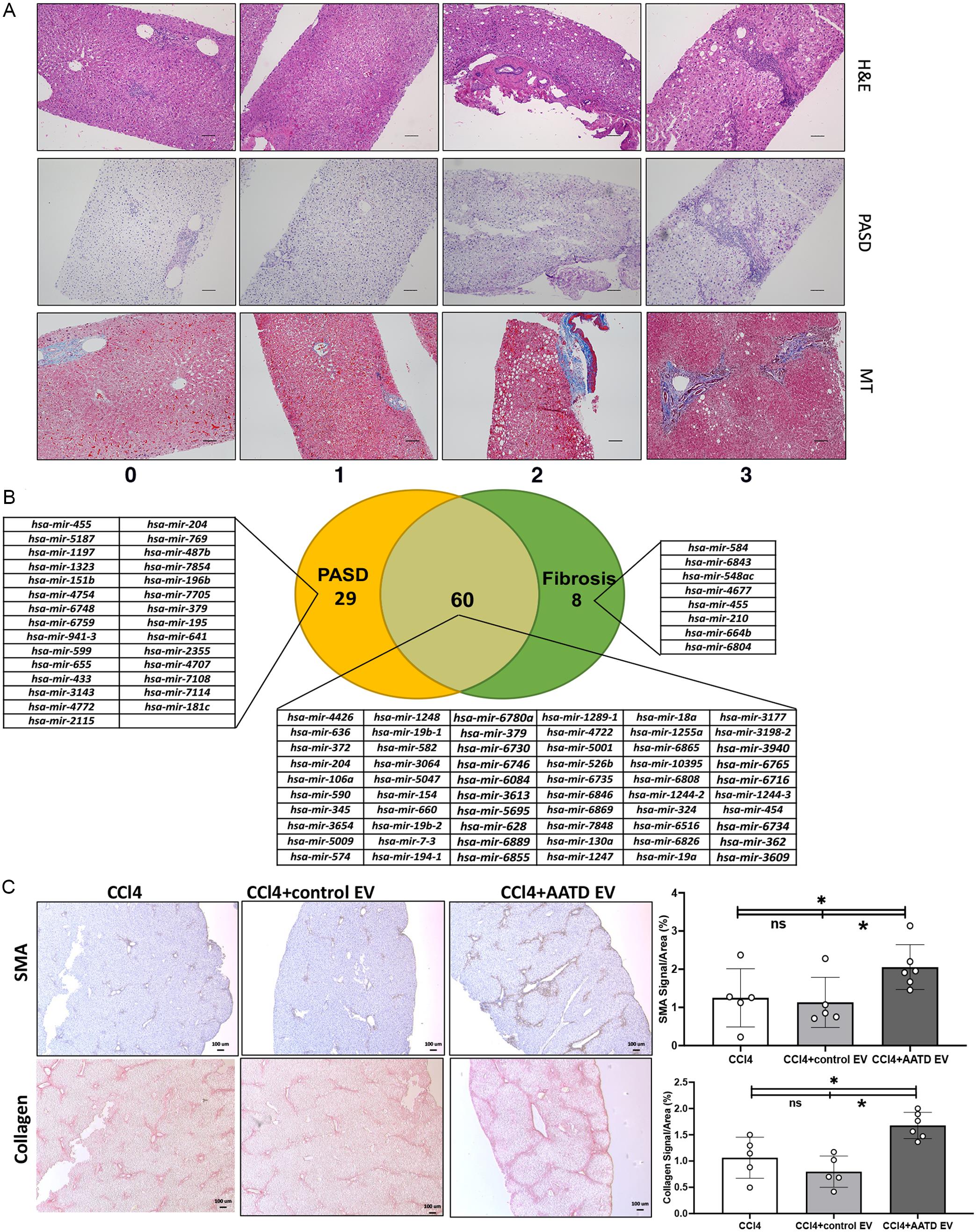 Correlation of plasma EVs associated miRNA profile with PASD and fibrosis scores in AATD individuals.