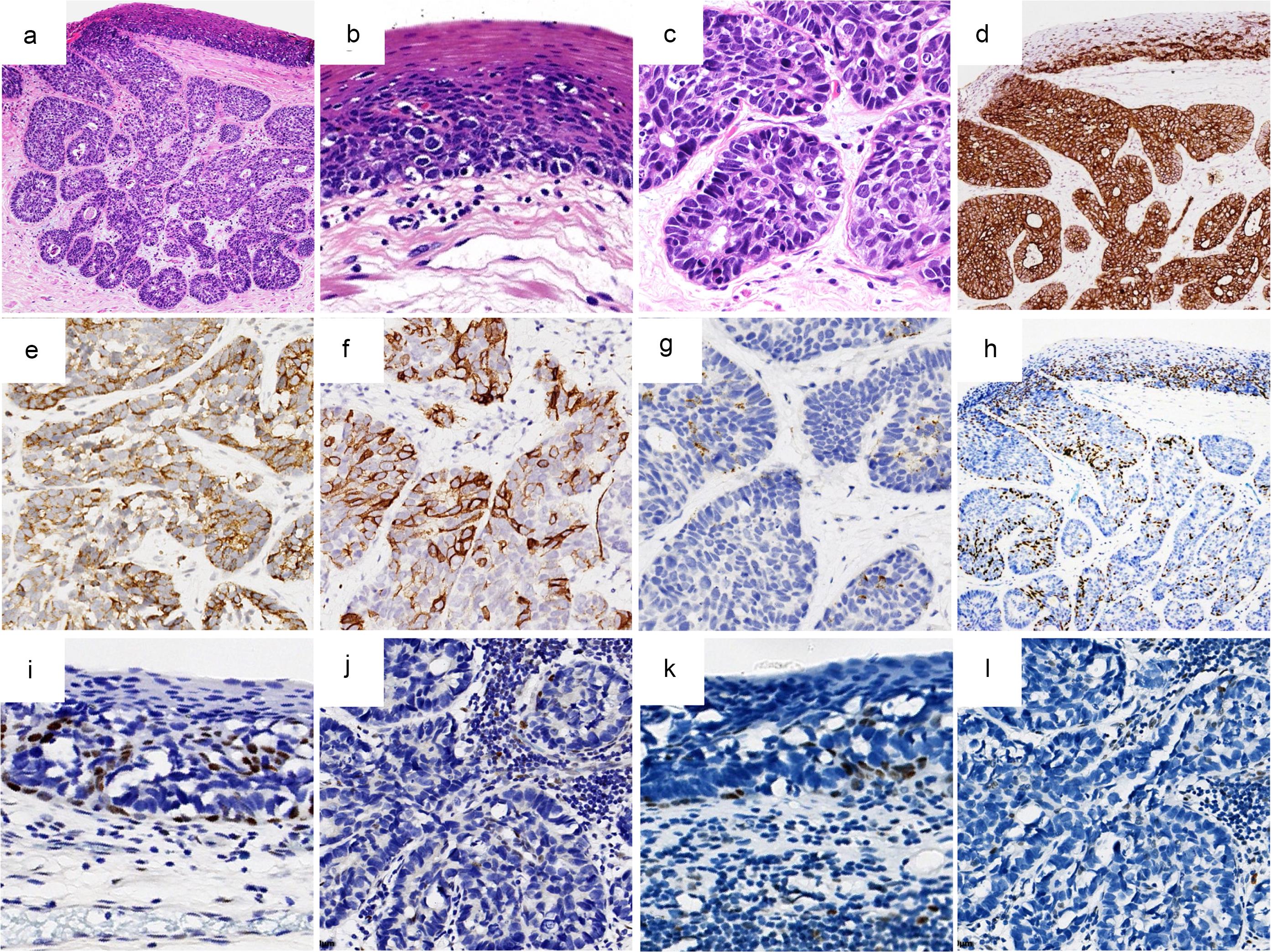 Pathological findings of esophageal Paget’s disease.